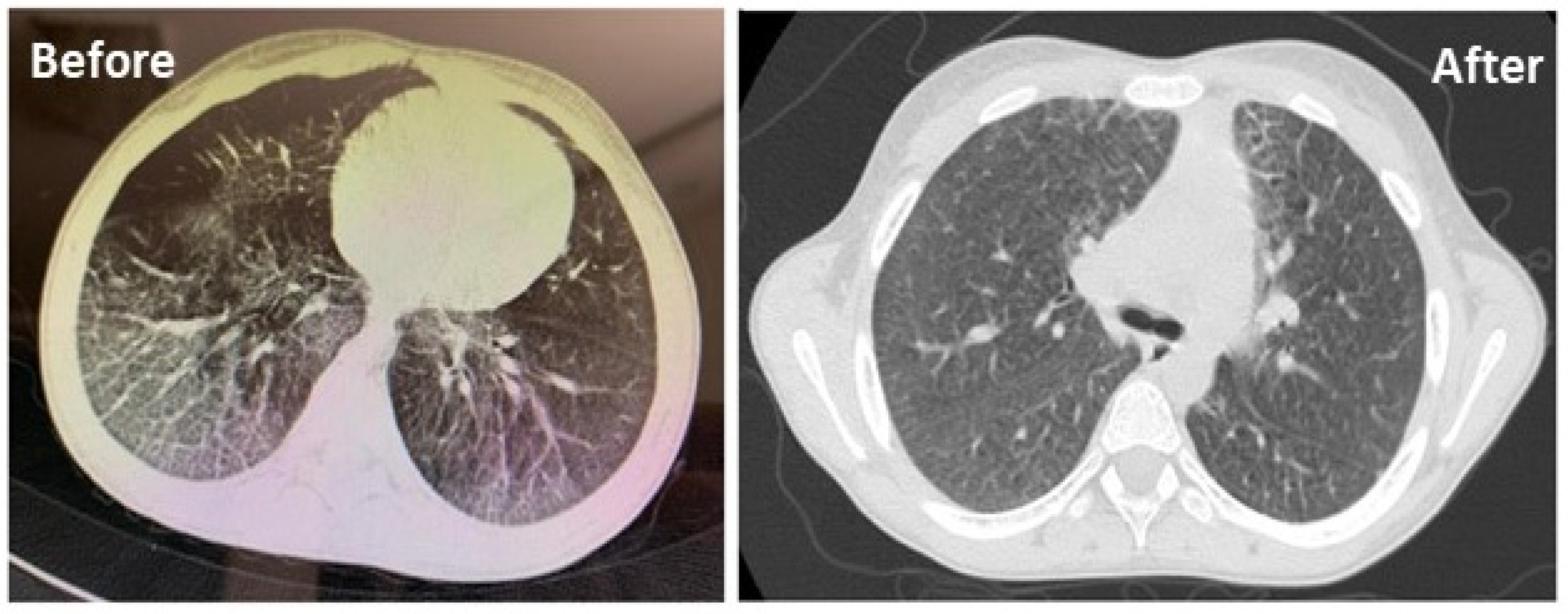 Niemann-Pick disease type B: HRCT assessment of pulmonary