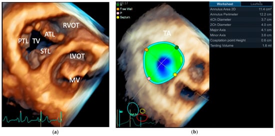 JCM | Free Full-Text | Atrial Functional Tricuspid Regurgitation