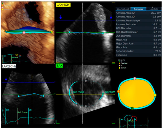 Jcm Free Full Text Atrial Functional Tricuspid Regurgitation As A Distinct Pathophysiological And Clinical Entity No Idiopathic Tricuspid Regurgitation Anymore Html