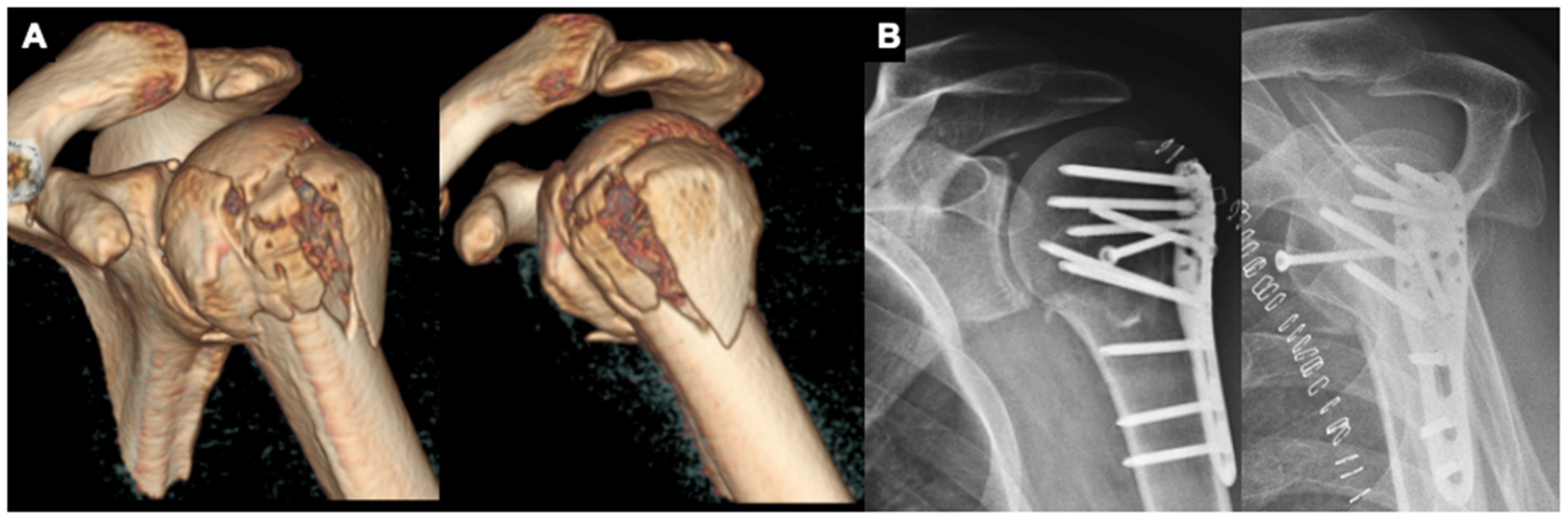 proximal humerus fracture