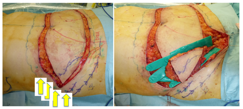 A retrospective study of lymphatic transverse rectus abdominis  myocutaneous/deep inferior epigastric perforator flaps for breast cancer  treatment-induced upper-limb lymphoedema