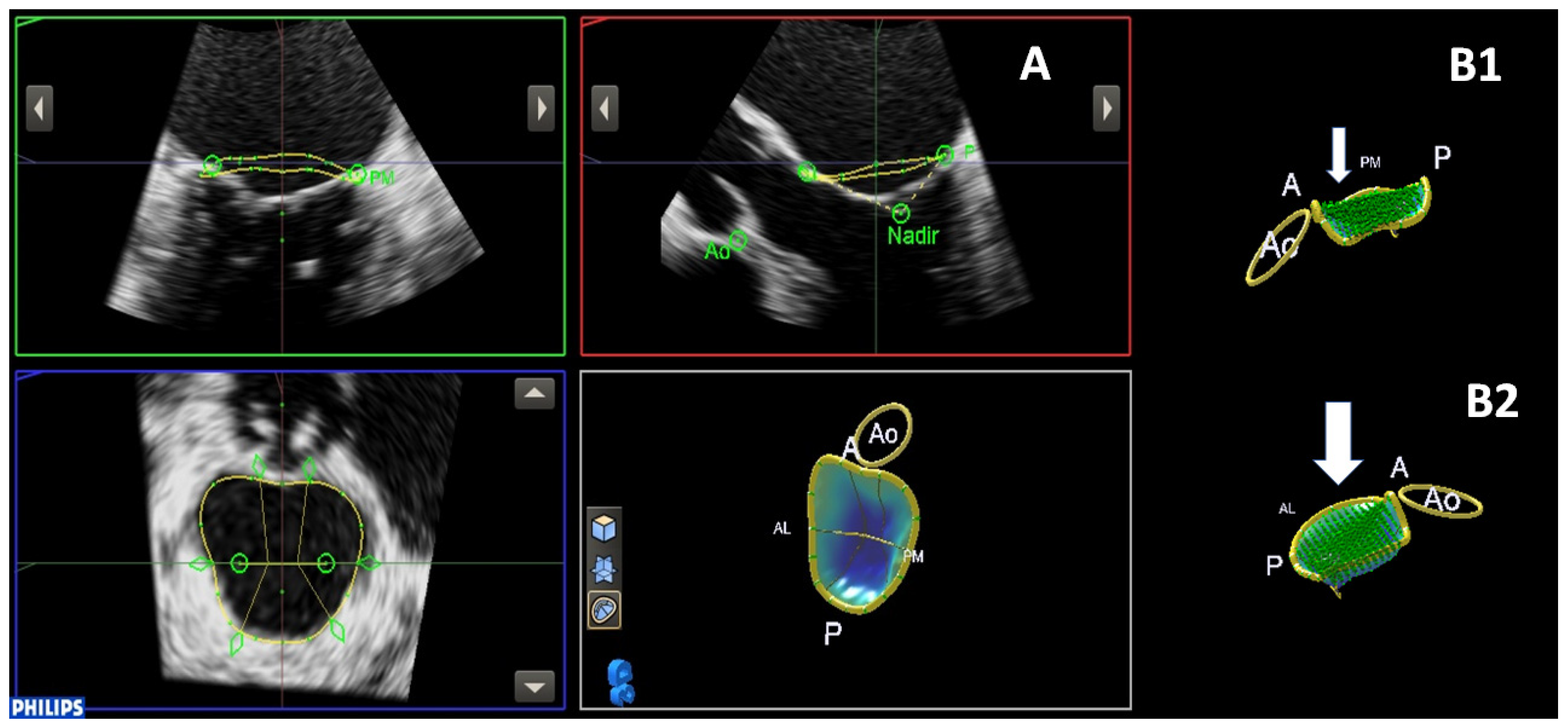 JCM | Free Full-Text | 3D Echo Characterization of Proportionate and  Disproportionate Functional Mitral Regurgitation before and after  Percutaneous Mitral Valve Repair | HTML