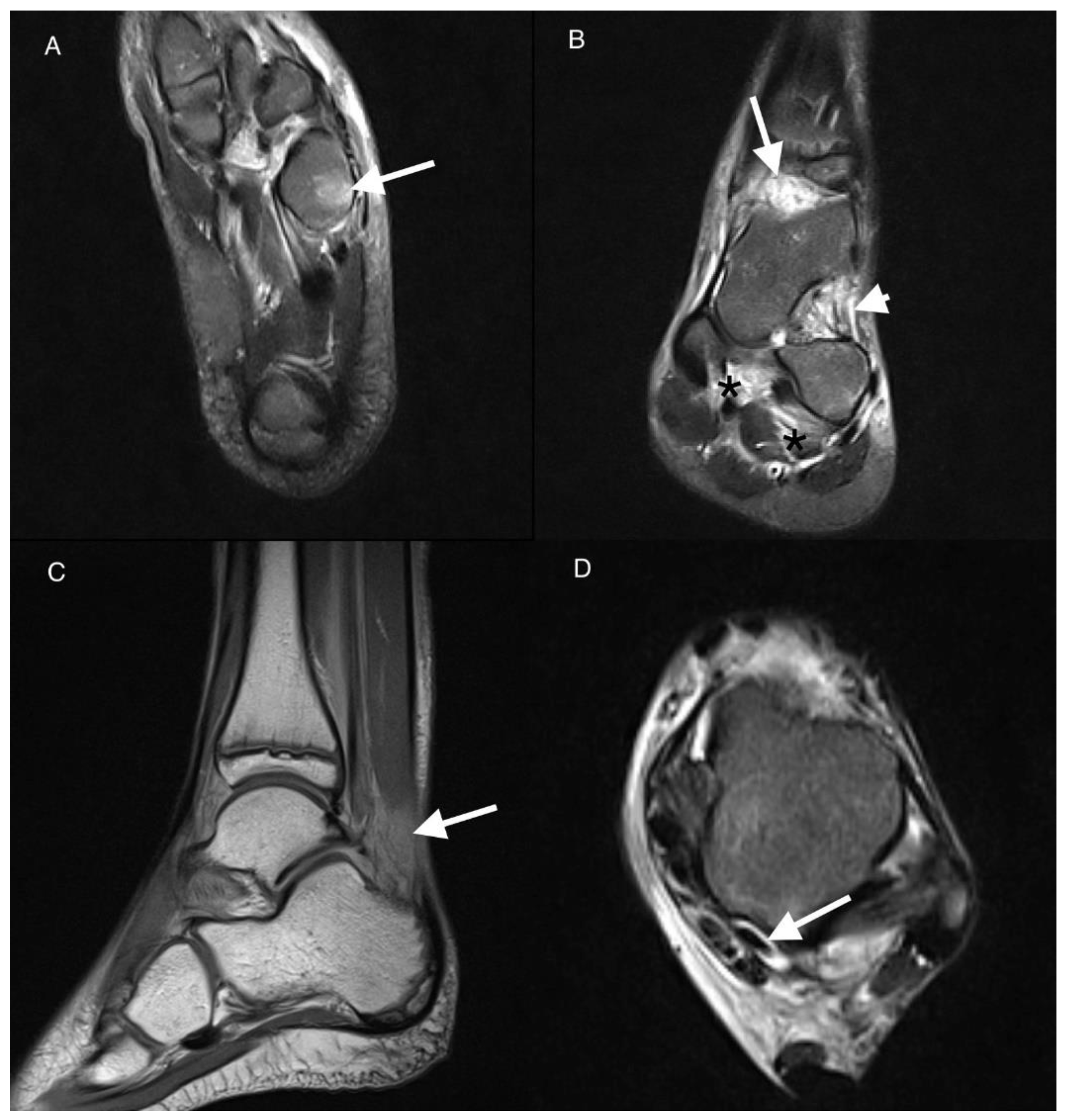 JCM | Free Full-Text | Ankle Magnetic Resonance Imaging in Juvenile  Idiopathic Arthritis Versus Non-Juvenile Idiopathic Arthritis Patients with  Arthralgia