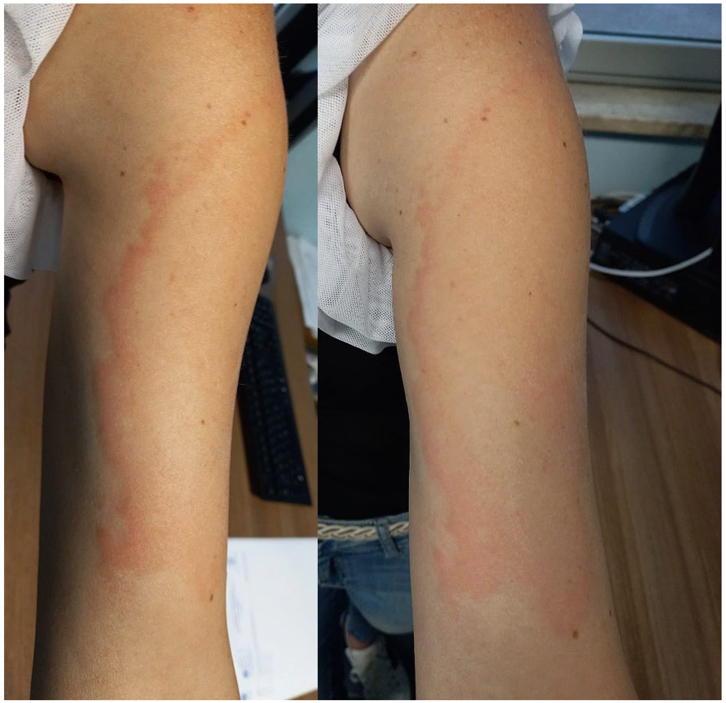 JCM | Free Full-Text | Erythema Migrans-like COVID Vaccine Arm: A  Literature Review