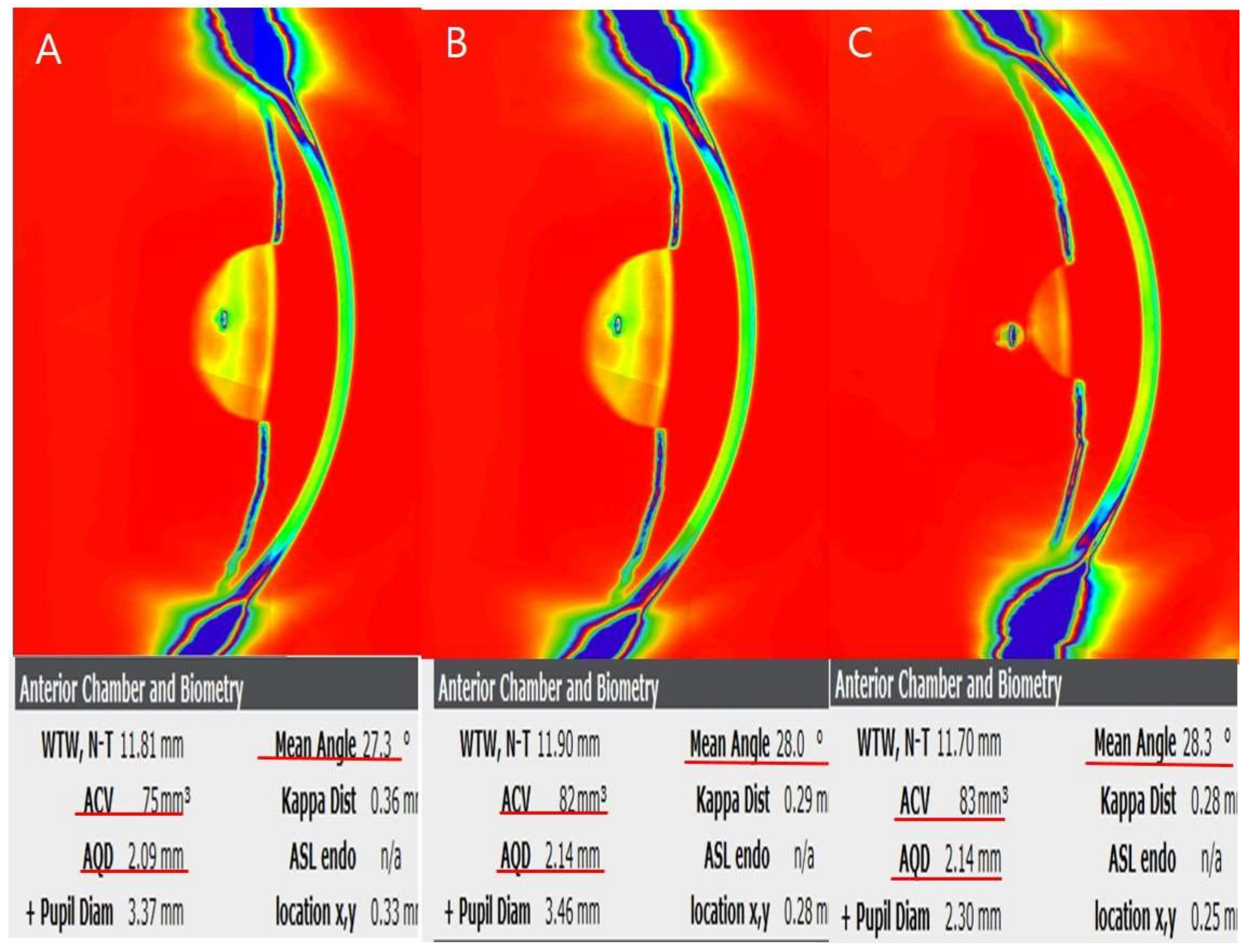 JCM | Free Full-Text | Long-Term Outcome of Corneal and Anterior Chamber  Angle Parameters after Combined Laser Iridotomy and Iridoplasty Using Dual  Scheimpflug Analyzer: 1 Year Results
