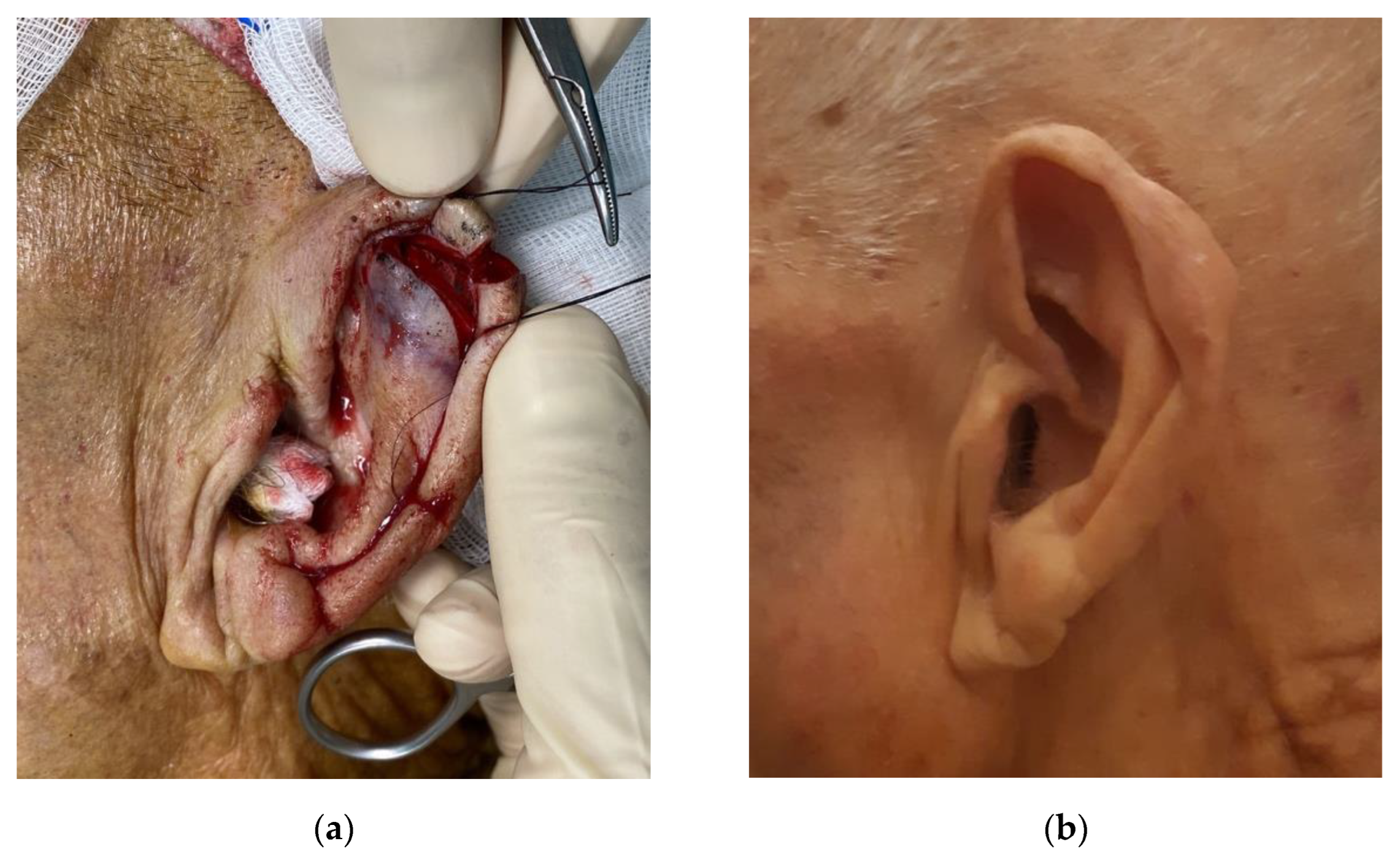squamous cell carcinoma ear