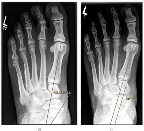 JCM | Free Full-Text | Adult-Acquired Flatfoot Deformity: Combined ...