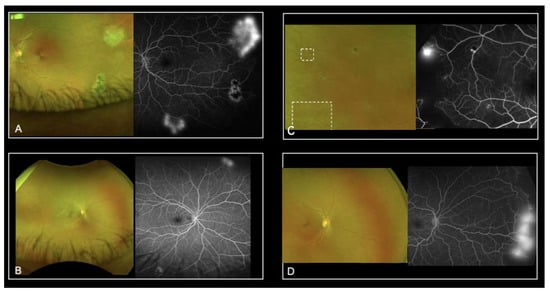 sickle cell retinopathy sea fan