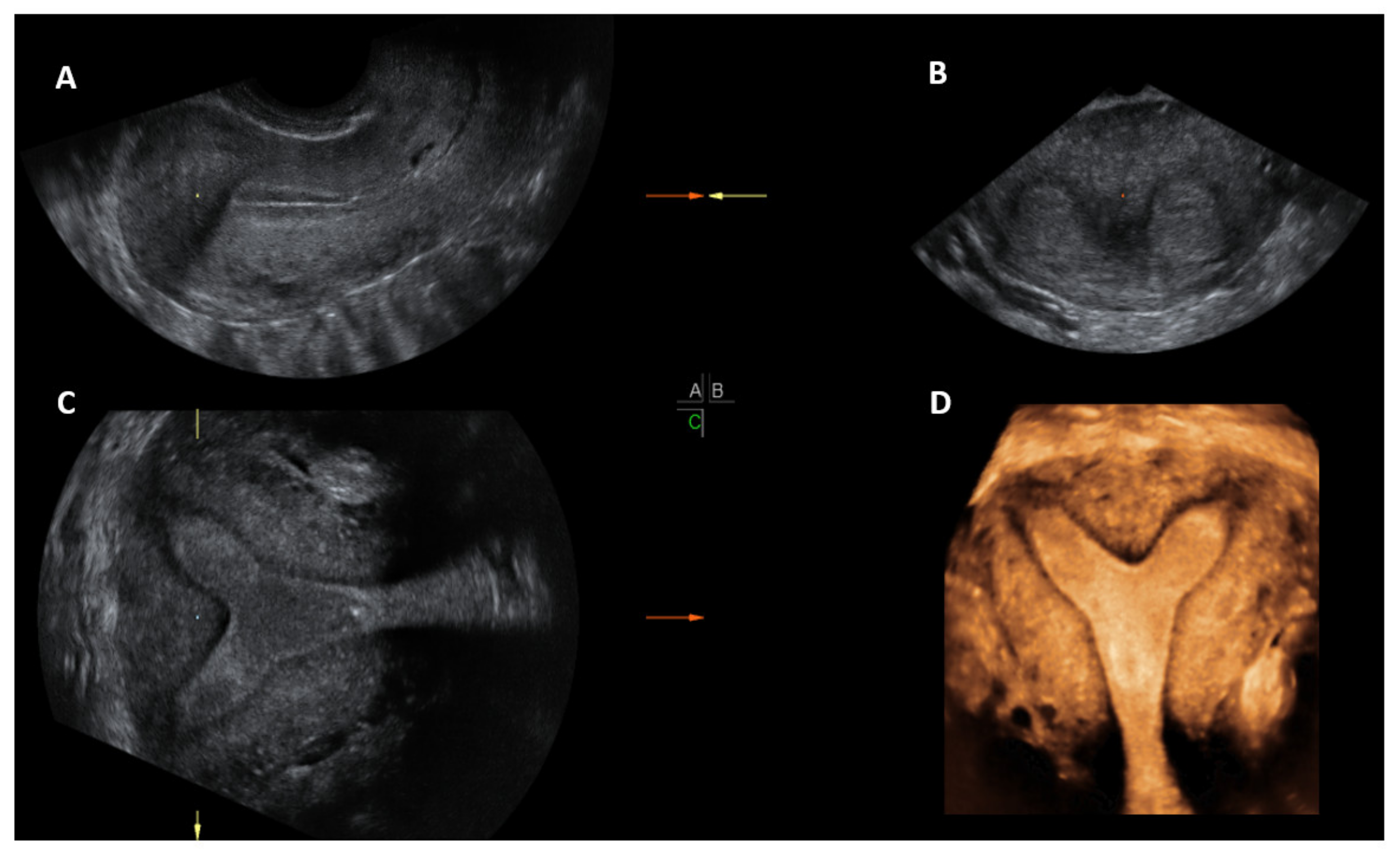 mullerian agenesis ultrasound