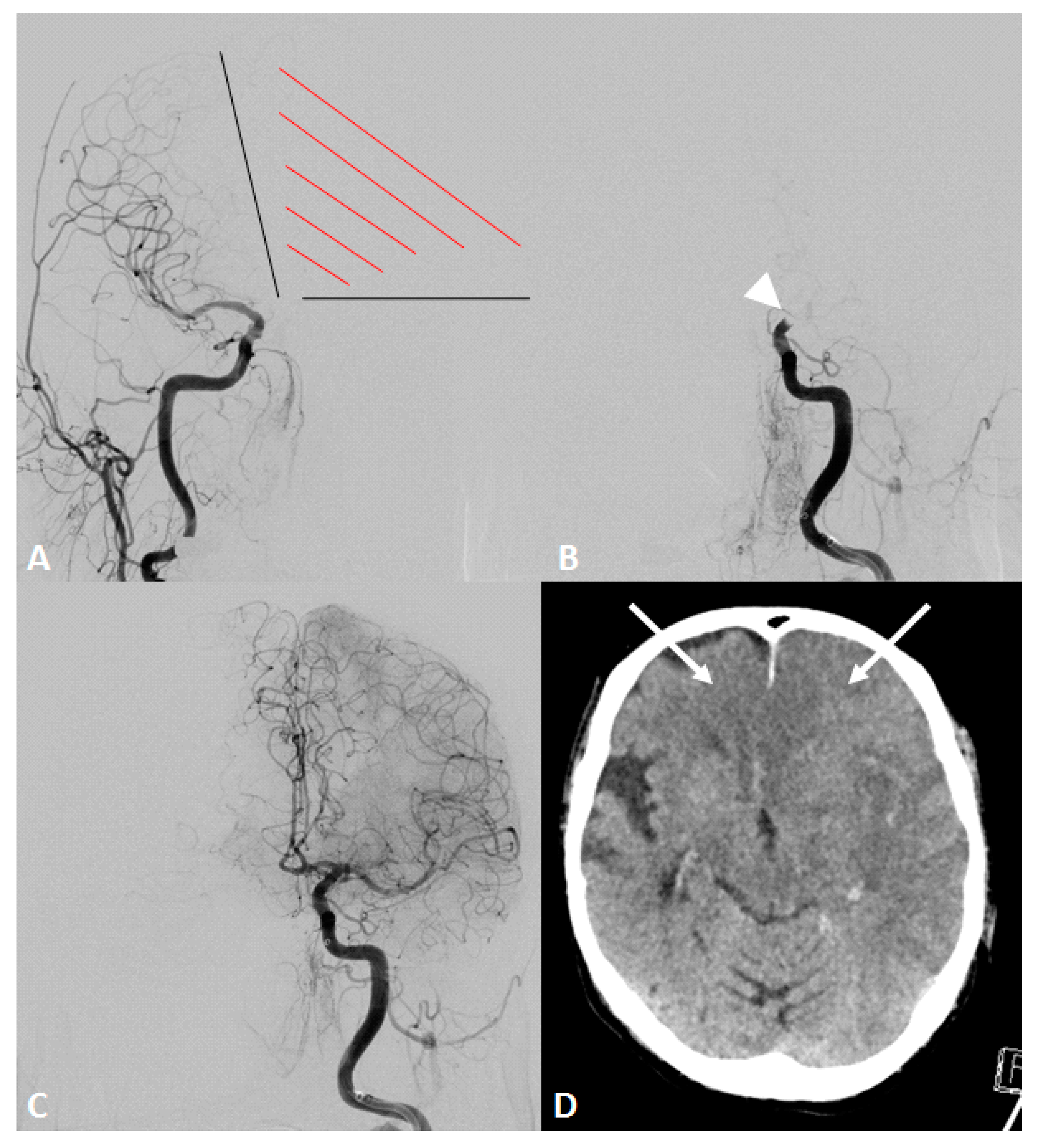 Jcm Free Full Text Functional Aplasia Of The Contralateral A1 Segment Influences Clinical