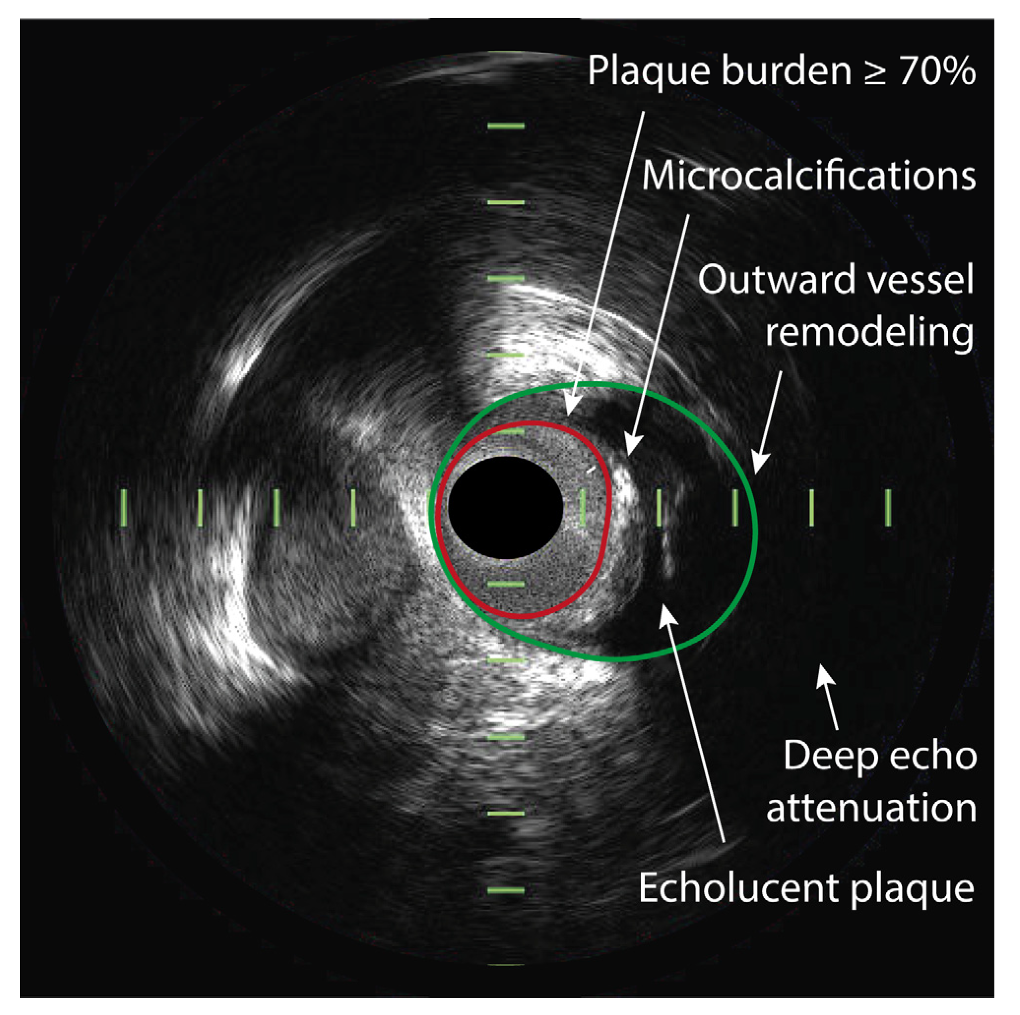 TCT-24. Combined Near-Infrared Spectroscopic and Intravascular Ultrasound  Assessment of Coronary Plaque Burden and Lipid Pools: Validation with  Histology