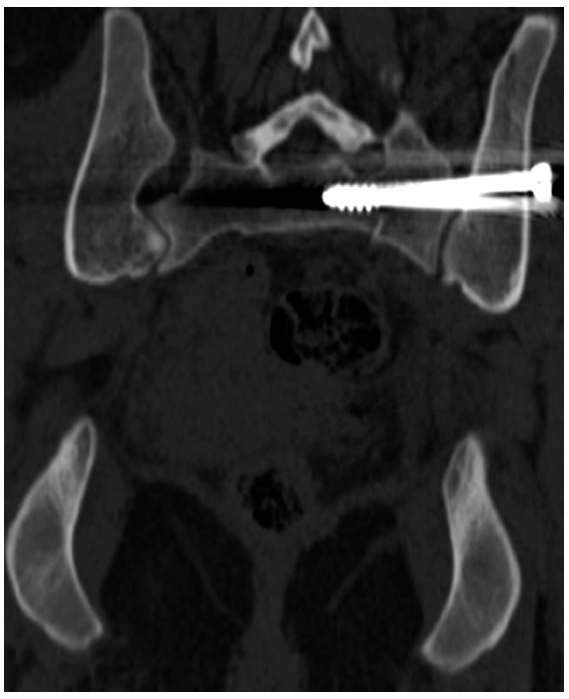 JCM | Free Full-Text | Differences in Accuracy and Radiation Dose in  Placement of Iliosacral Screws: Comparison between 3D and 2D Fluoroscopy