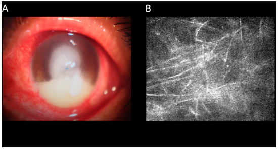 JCM | Special Issue : Advances In The Diagnosis And Treatment Of Ocular ...