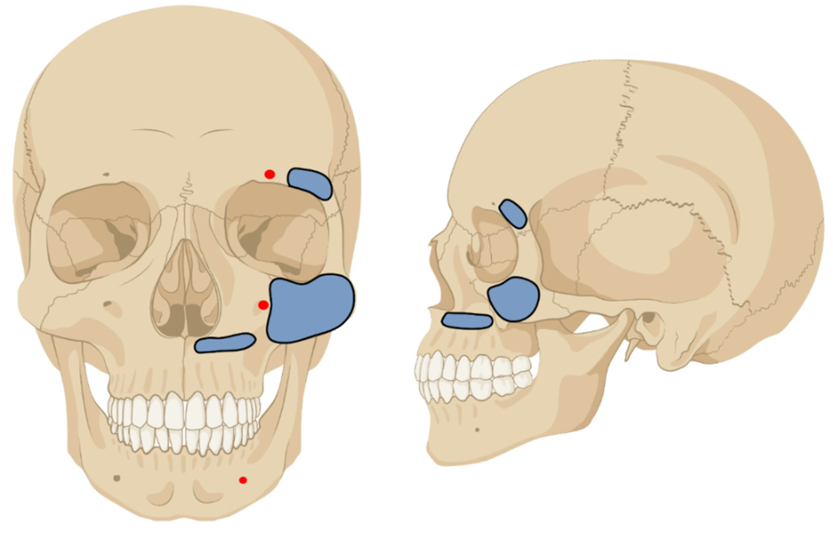JCM | Free Full-Text | Off-Label Treatment for Severe Craniomaxillofacial  Fractures in Low-Income Countries&mdash;A Novel Operation Method with the  External Face Fixator | HTML