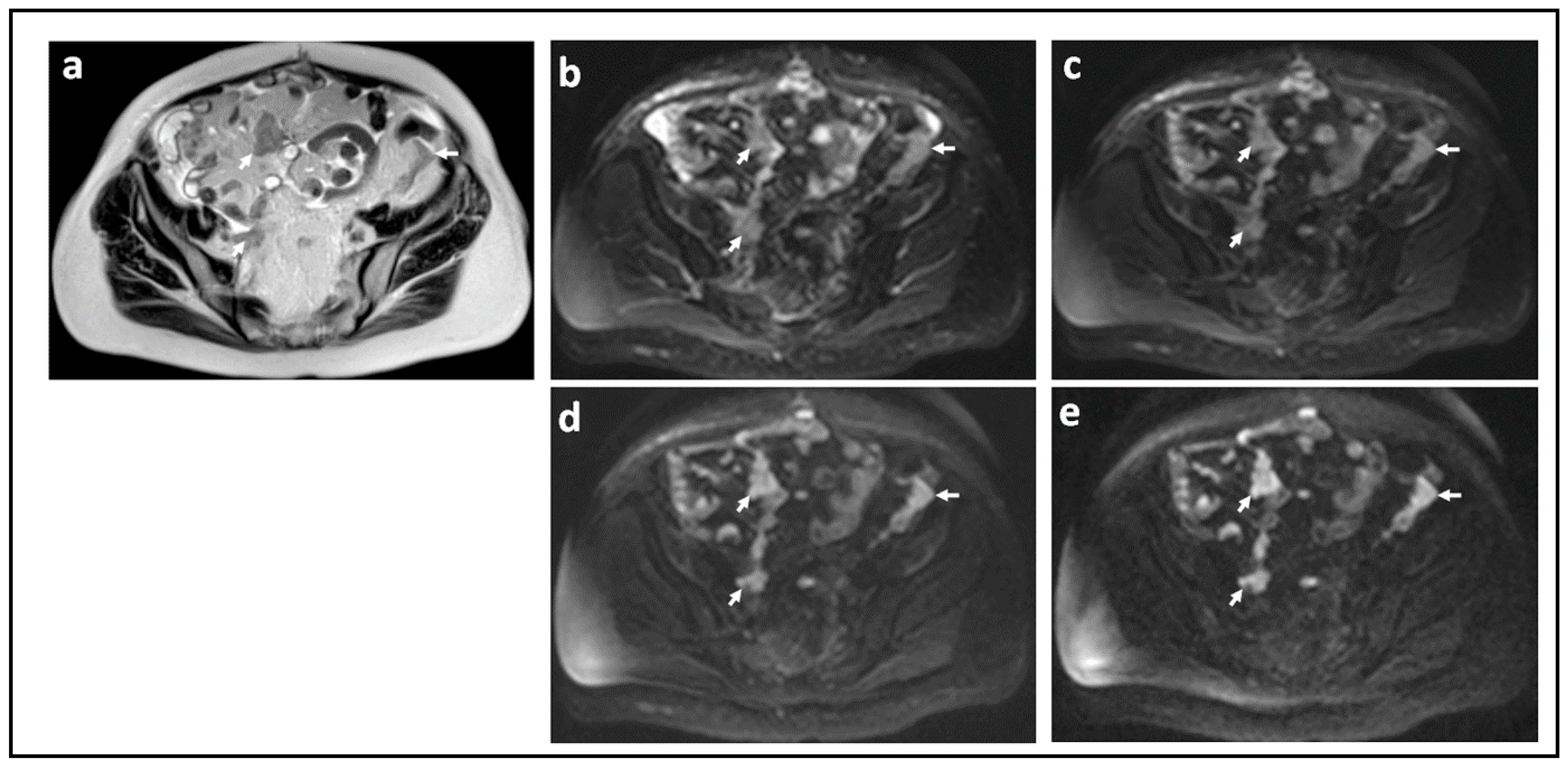 Comparison of SI with b value of 1000 s/mm2 in malignant and benign