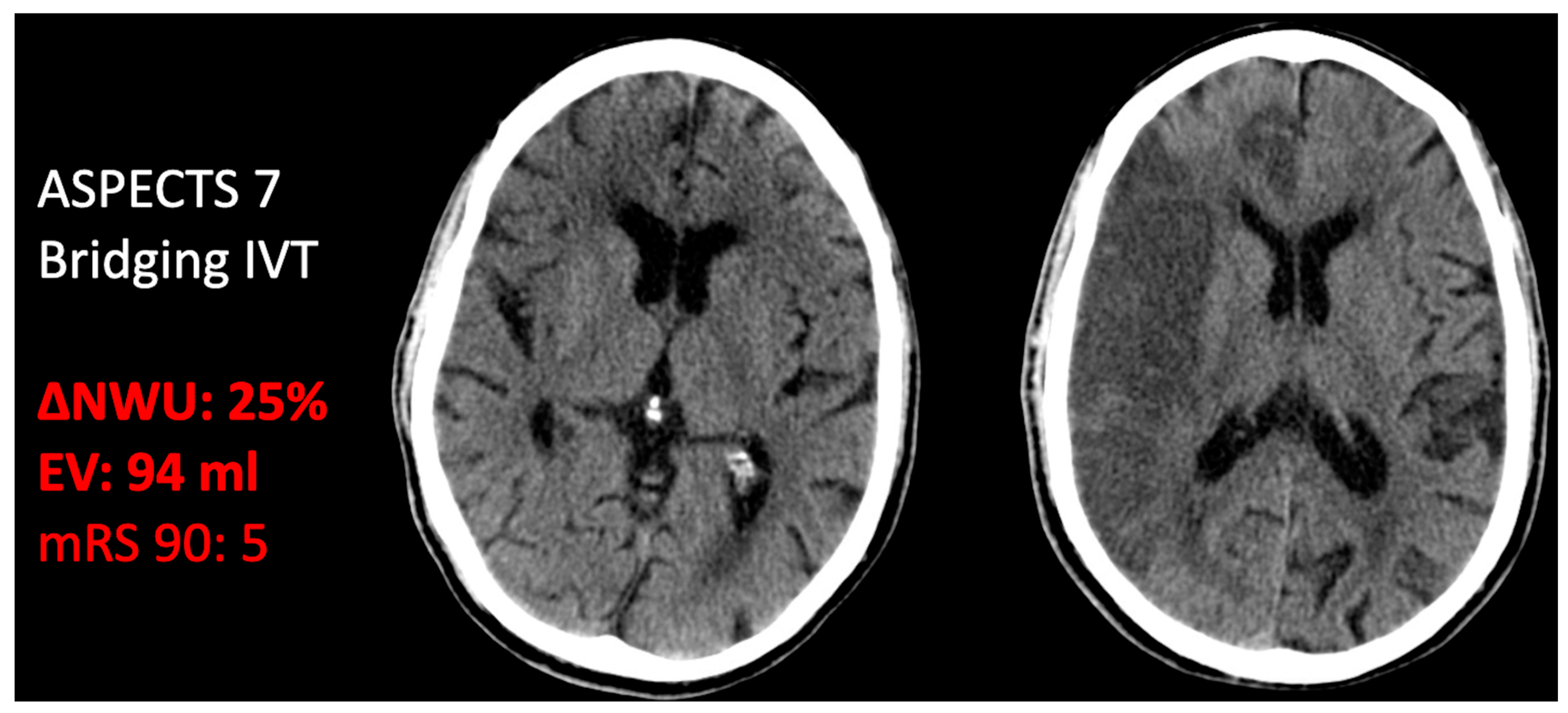 JCM | Free Full-Text | Effect of Intravenous Alteplase on Functional  Outcome and Secondary Injury Volumes in Stroke Patients with Complete  Endovascular Recanalization | HTML