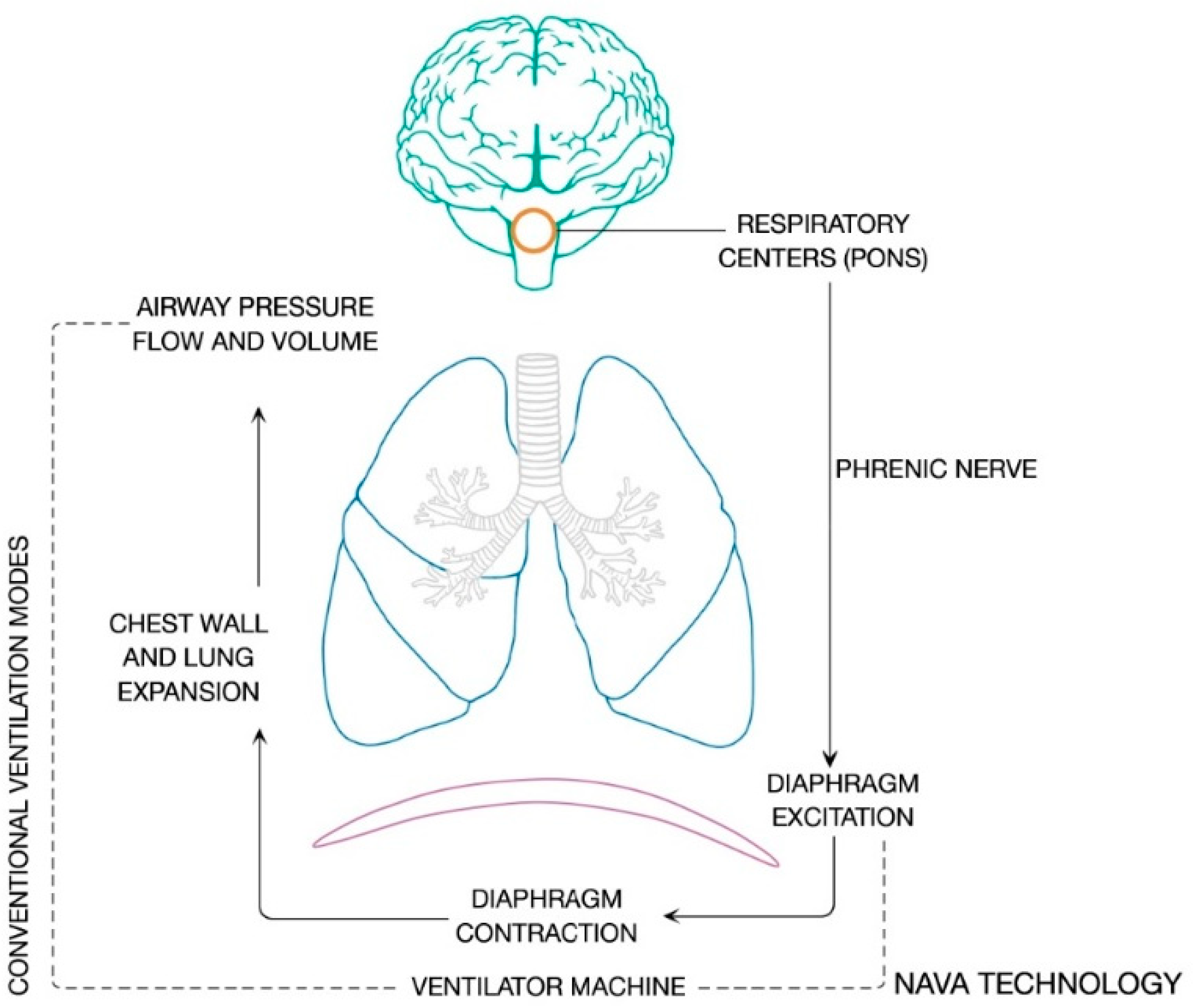 JCM | Free Full-Text | Neurally Adjusted Ventilatory Assist in Acute  Respiratory Failure&mdash;A Narrative Review