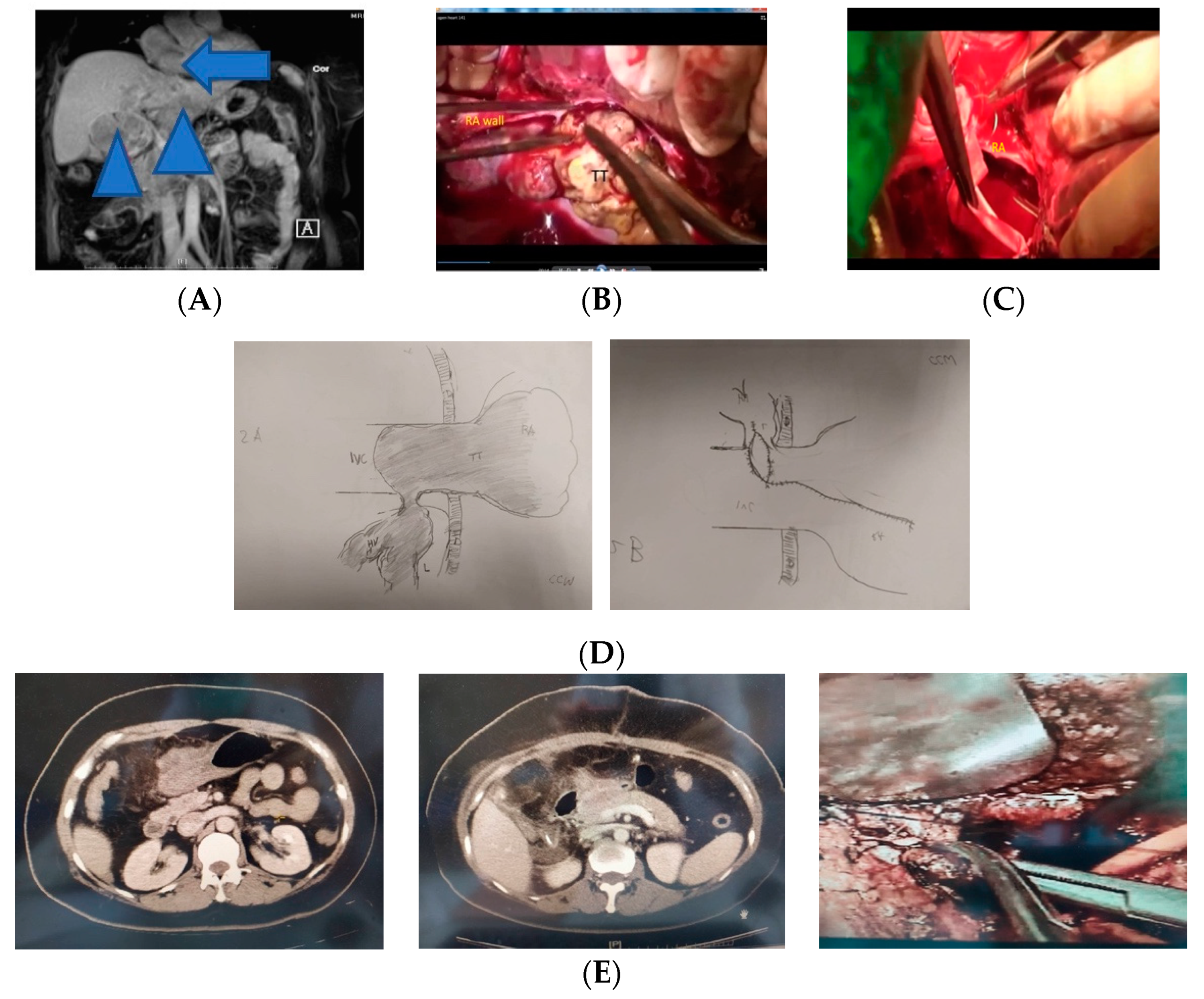 JCM | Free Full-Text | Concomitant Hepatectomy and Atrial Thrombectomy  under Cardiopulmonary Bypass versus Staged Hepatectomy in the Treatment for  Hepatocellular Carcinoma with Large Right Atrial Tumor Thrombi | HTML