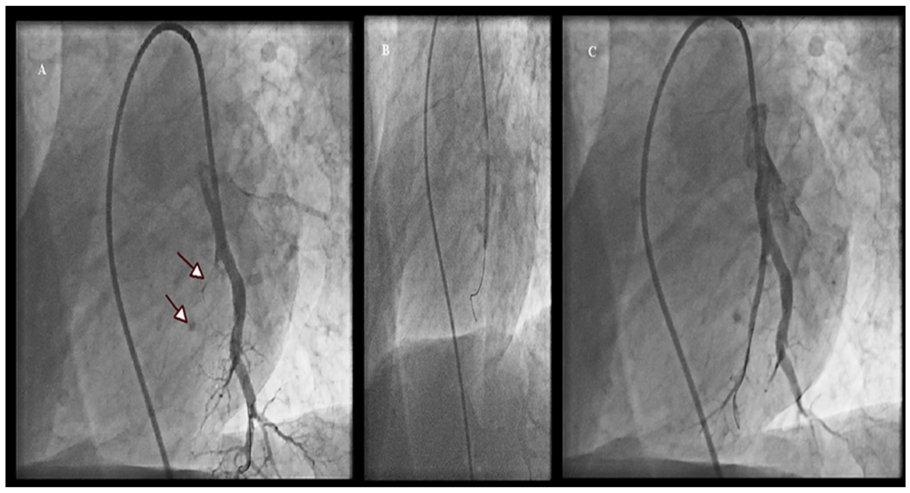 JCM | Free Full-Text | Balloon Pulmonary Angioplasty in Patients with  Chronic Thromboembolic Pulmonary Hypertension in Greece: Data from the  Hellenic Pulmonary Hypertension Registry