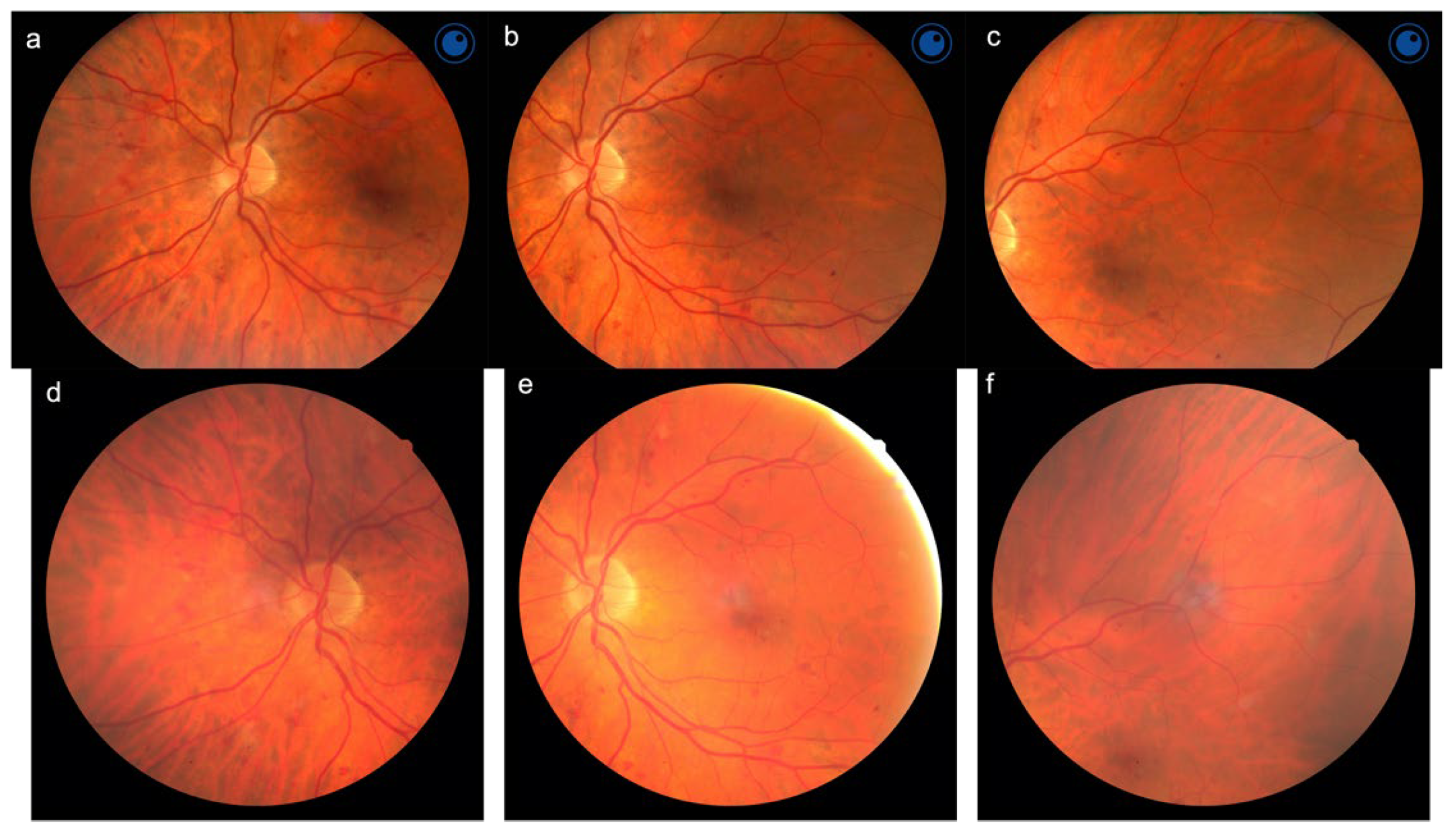 JCM | Free Full-Text | Handheld Fundus Camera for Diabetic Retinopathy  Screening: A Comparison Study with Table-Top Fundus Camera in Real-Life  Setting