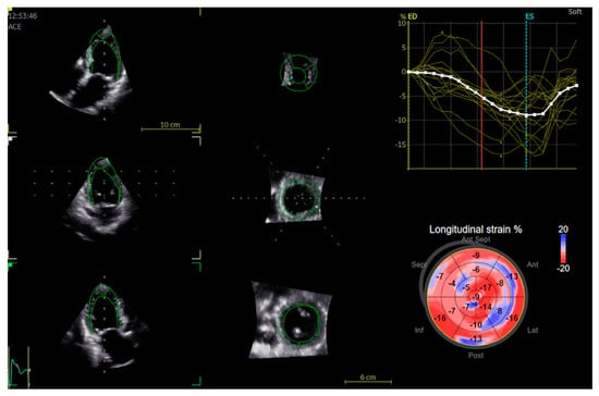 Global longitudinal strain is a more reproducible measure of left