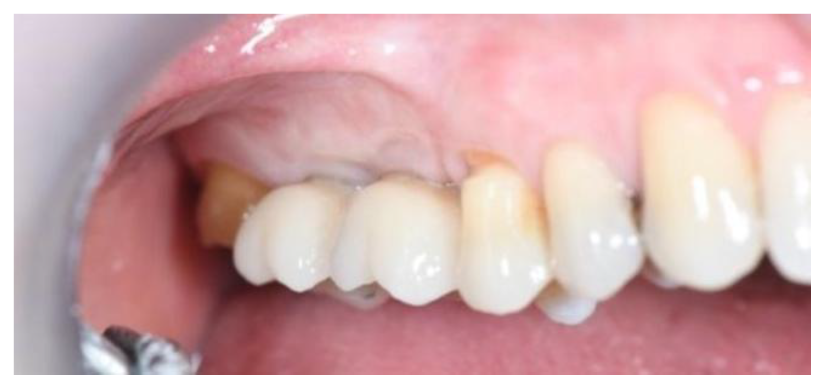 JCM | Free Full-Text | Long-Term Outcomes of Implants Placed in Maxillary  Sinus Floor Augmentation with Porous Fluorohydroxyapatite (Algipore&reg;  FRIOS&reg;) in Comparison with Anorganic Bovine Bone (Bio-Oss&reg;) and  Platelet Rich Plasma (PRP):
