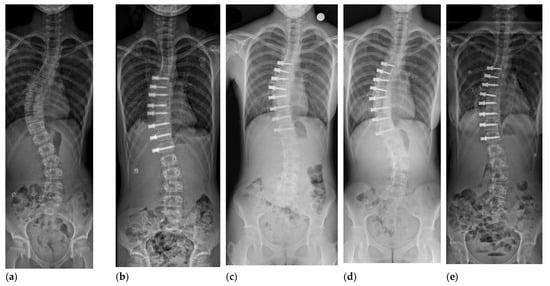 JCM | Free Full-Text | Vertebral Body Tethering: Indications, Surgical  Technique, and a Systematic Review of Published Results