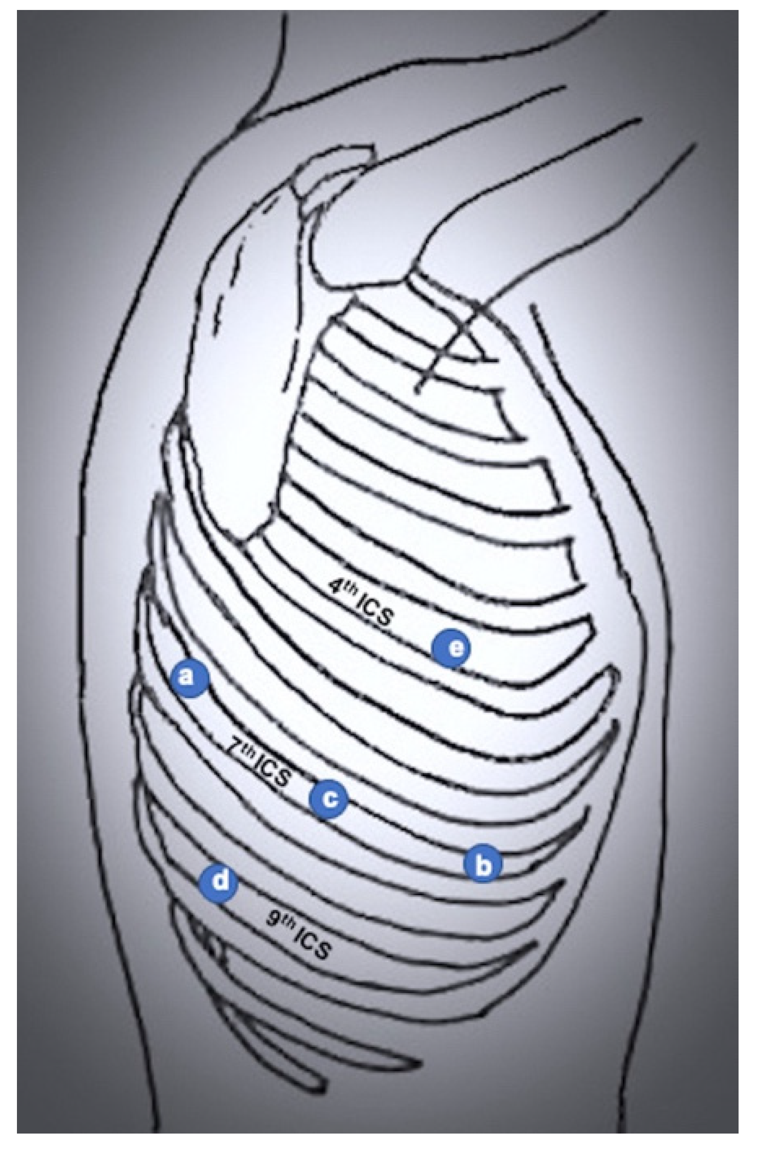 Port placement locations for both MP (A) and SP (B) RS-RALP approaches.