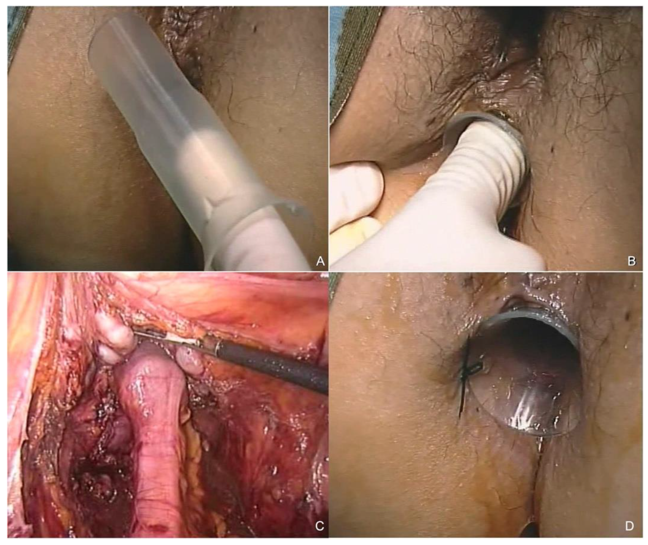 JCM Free Full Text Could Stoma Be Avoided after Laparoscopic