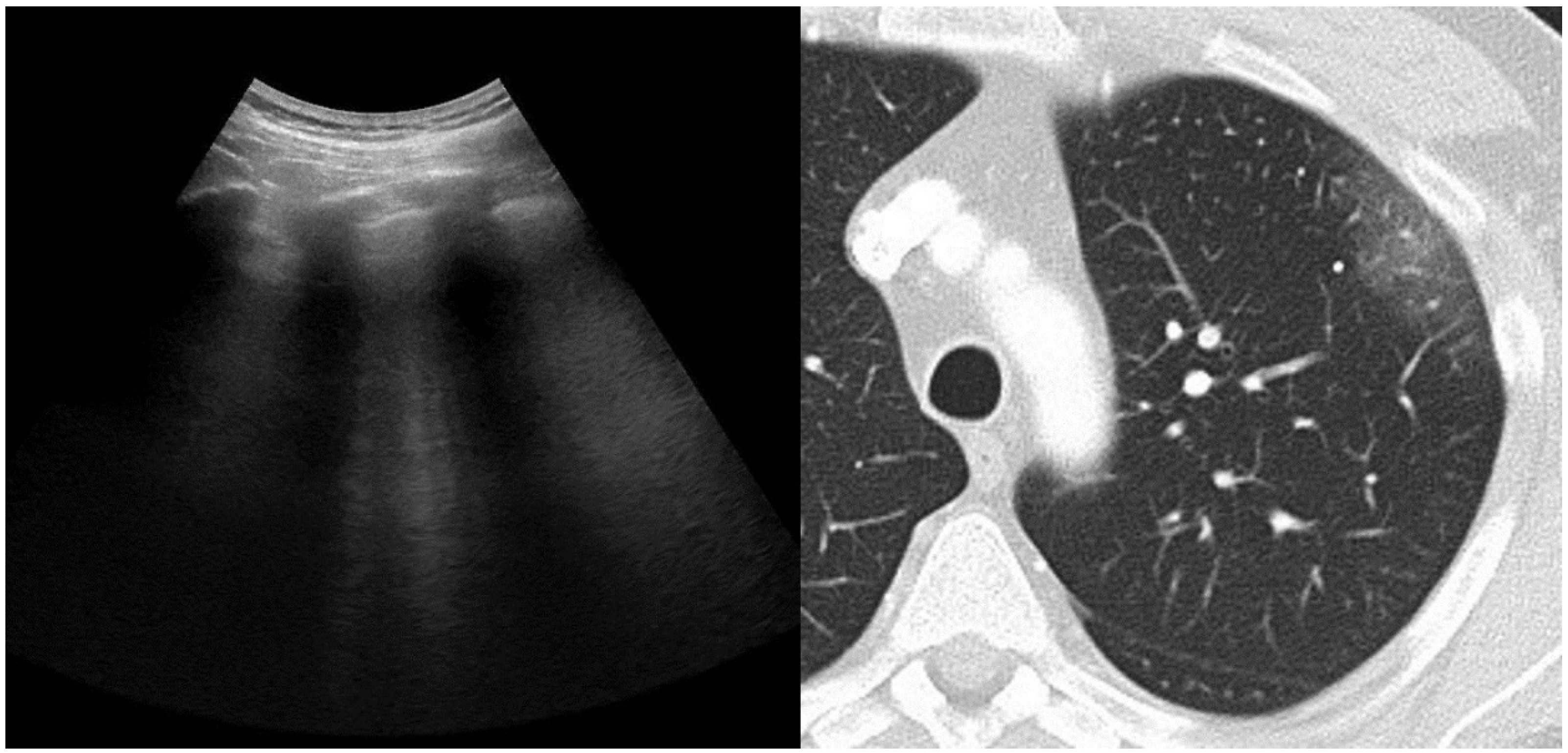 JCM | Free Full-Text | Lung Aeration in COVID-19 Pneumonia by  Ultrasonography and Computed Tomography