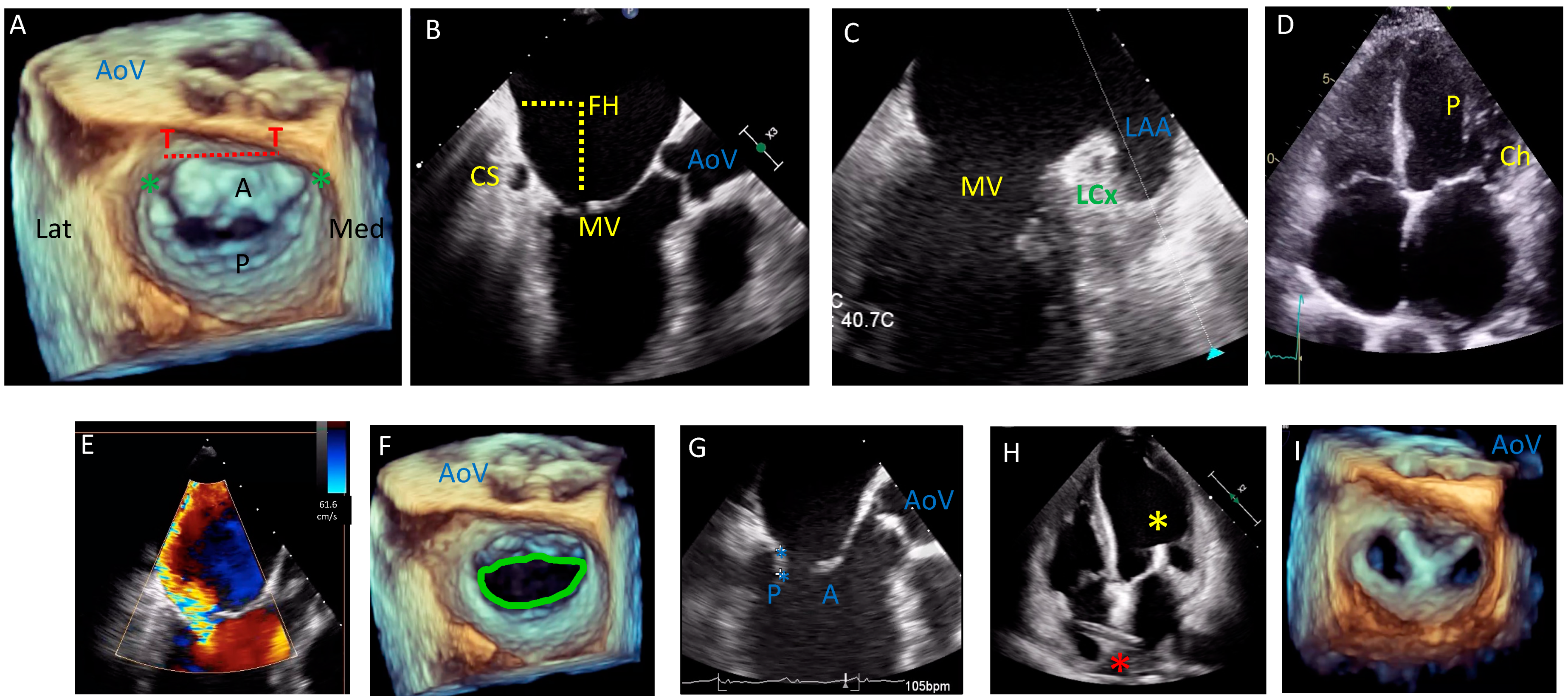 Transesophageal Echocardiogram (TEE)