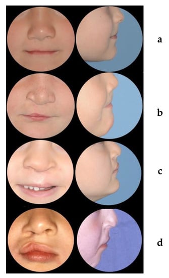 JCM | Free Full-Text | Nasolabial Appearance in 5-Year-Old Patients with  Repaired Complete Unilateral Cleft Lip and Palate: A Comparison of Two  Different Techniques of Lip Repair