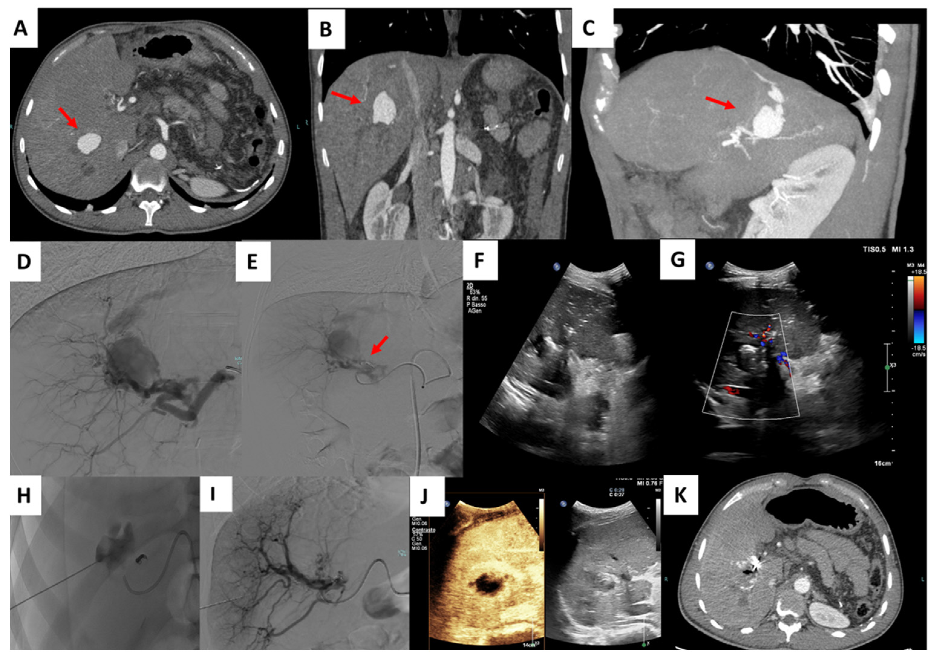 JCM | Free Full-Text | Imaging-Guided Percutaneous Puncture and  Embolization of Visceral Pseudoaneurysms: Feasibility and Outcomes