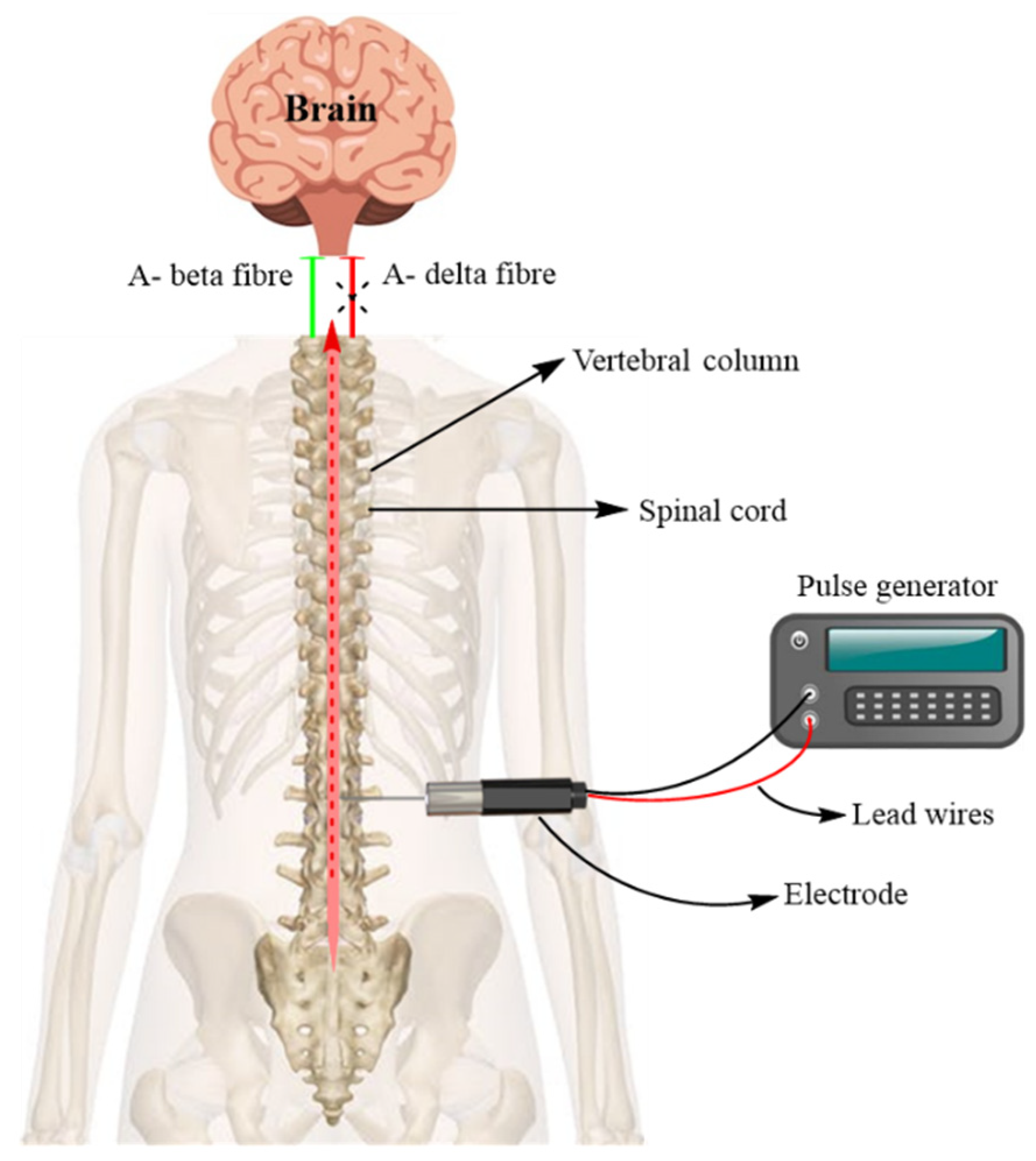 Electrode placement and settings for TENS that I found useful for L5 S1  sciatica. Descriptions in comments. : r/Sciatica