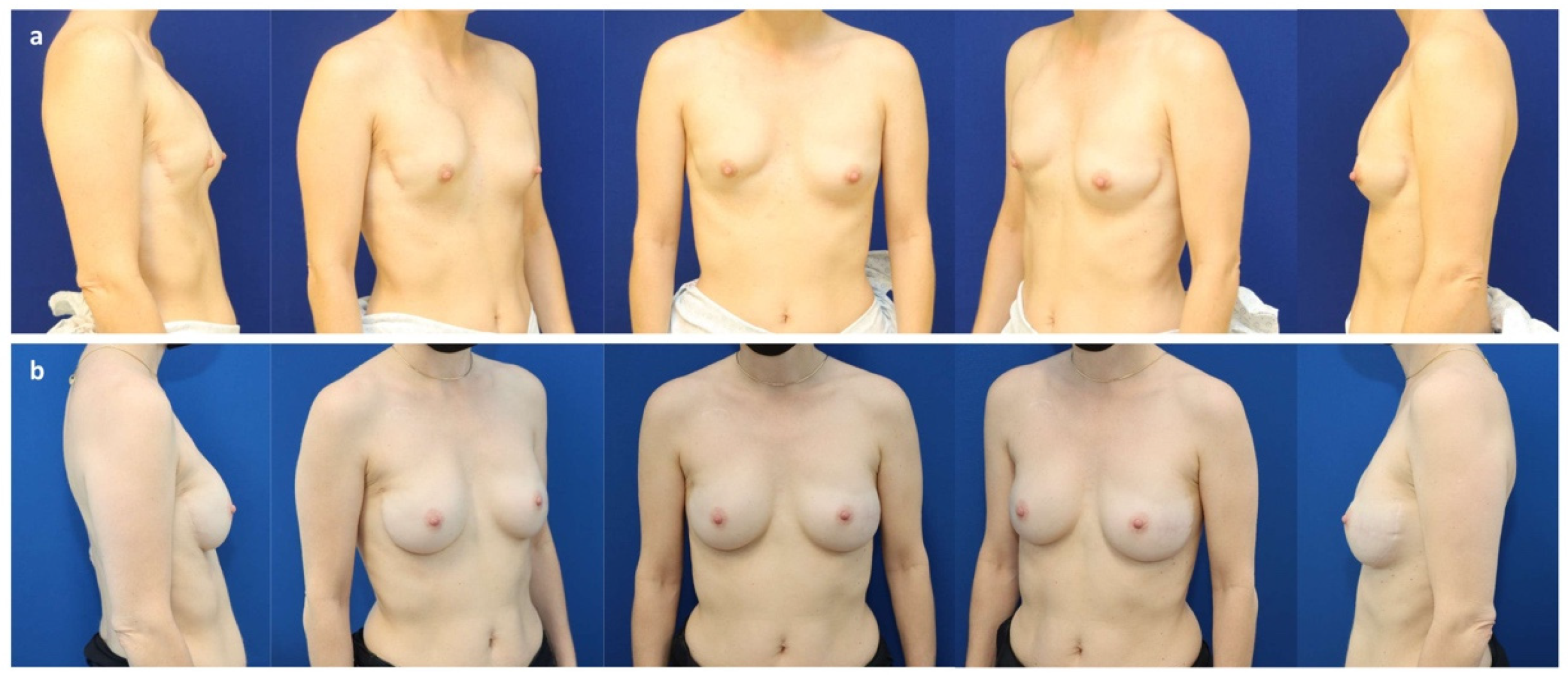 JCM Free Full-Text Implant-Based Breast Reconstruction after Mastectomy, from the Subpectoral to the Prepectoral Approach An Evidence-Based Change of Mind?