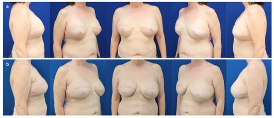Successful fat-only whole breast reconstruction using cultured