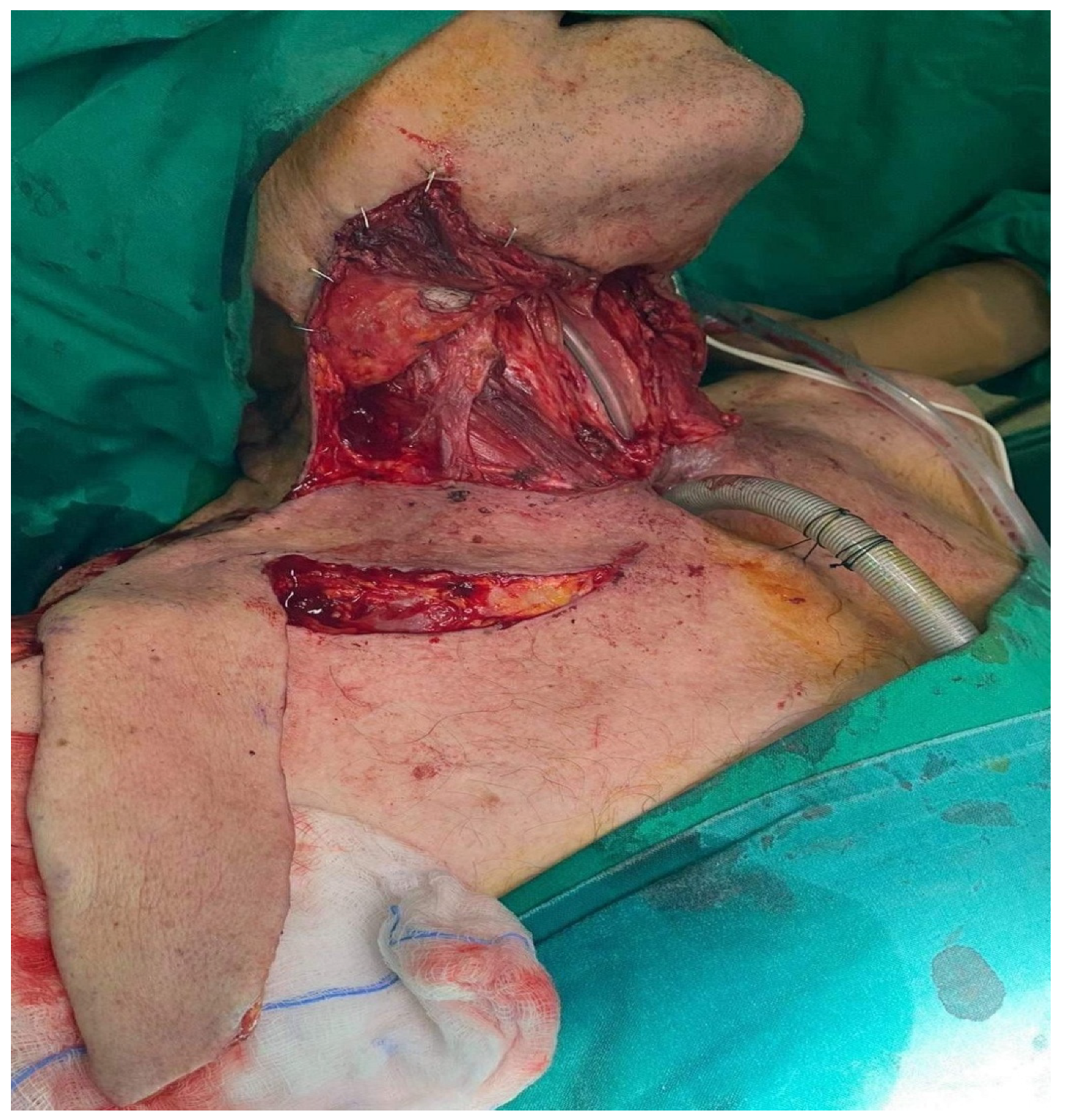 JCM | Free Full-Text | The Supraclavicular Artery Island Flap for