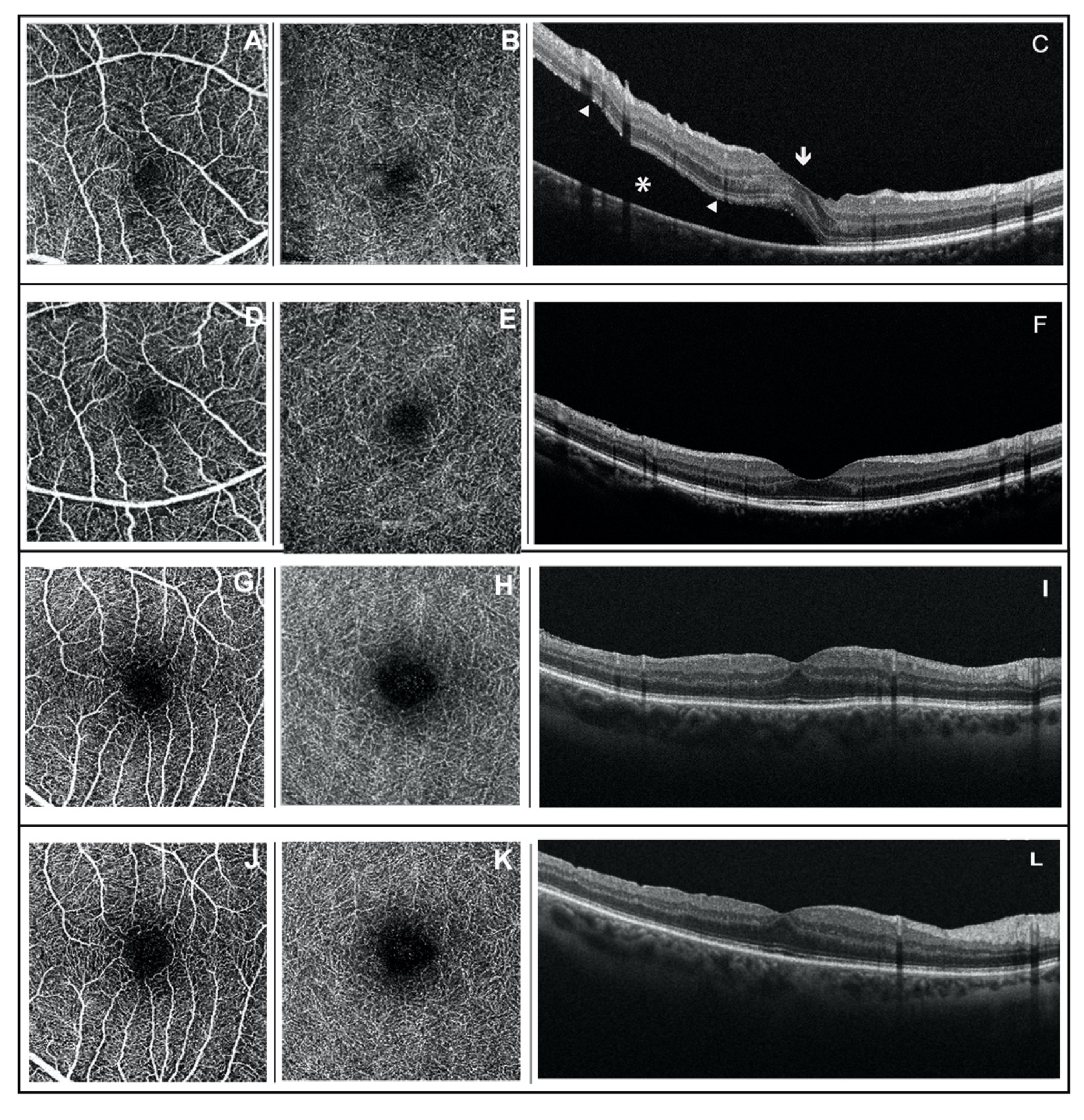 rhegmatogenous retinal detachment oct