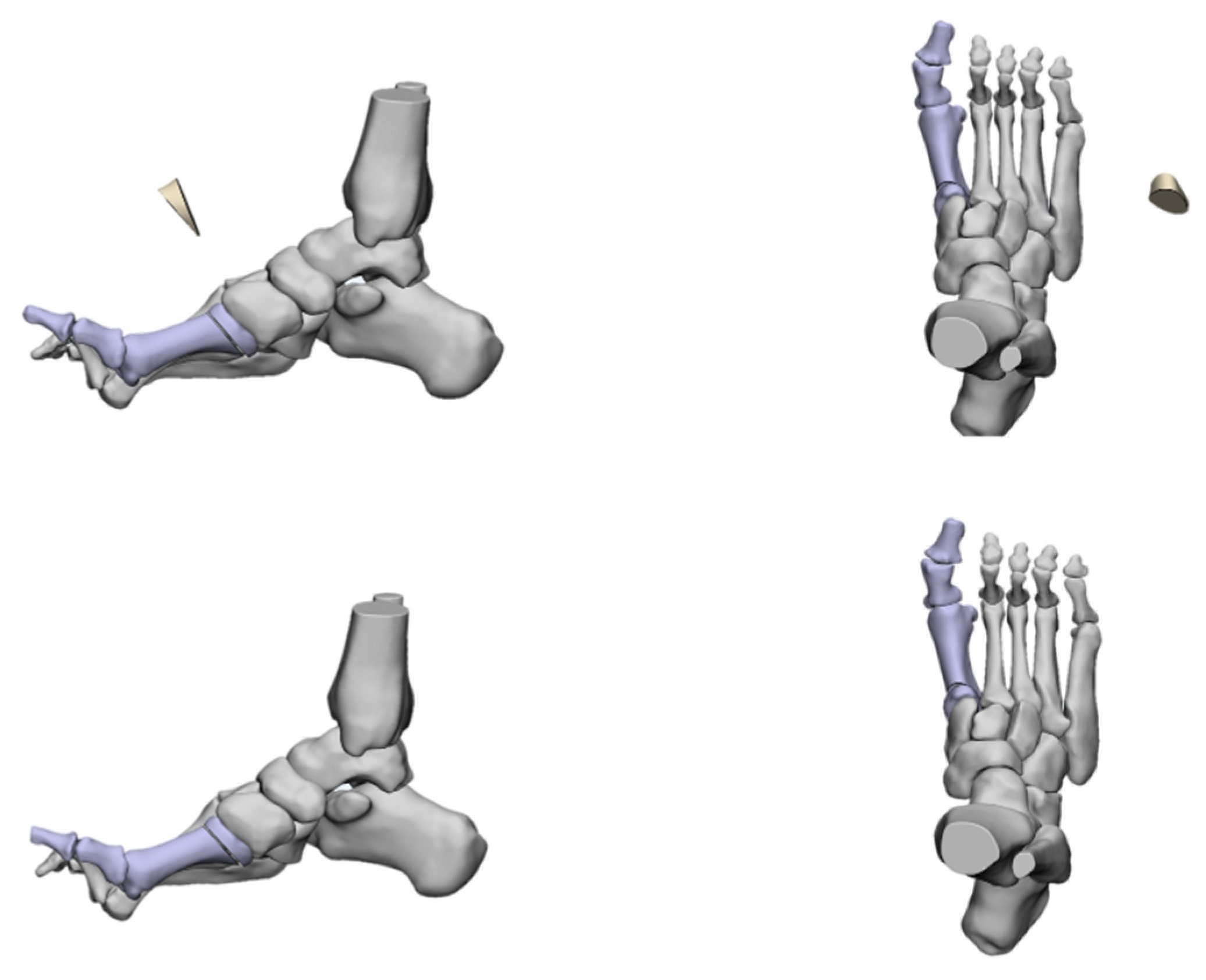 Jcm Free Full Text Evaluation And Management Of Cavus Foot In Adults A Narrative Review 