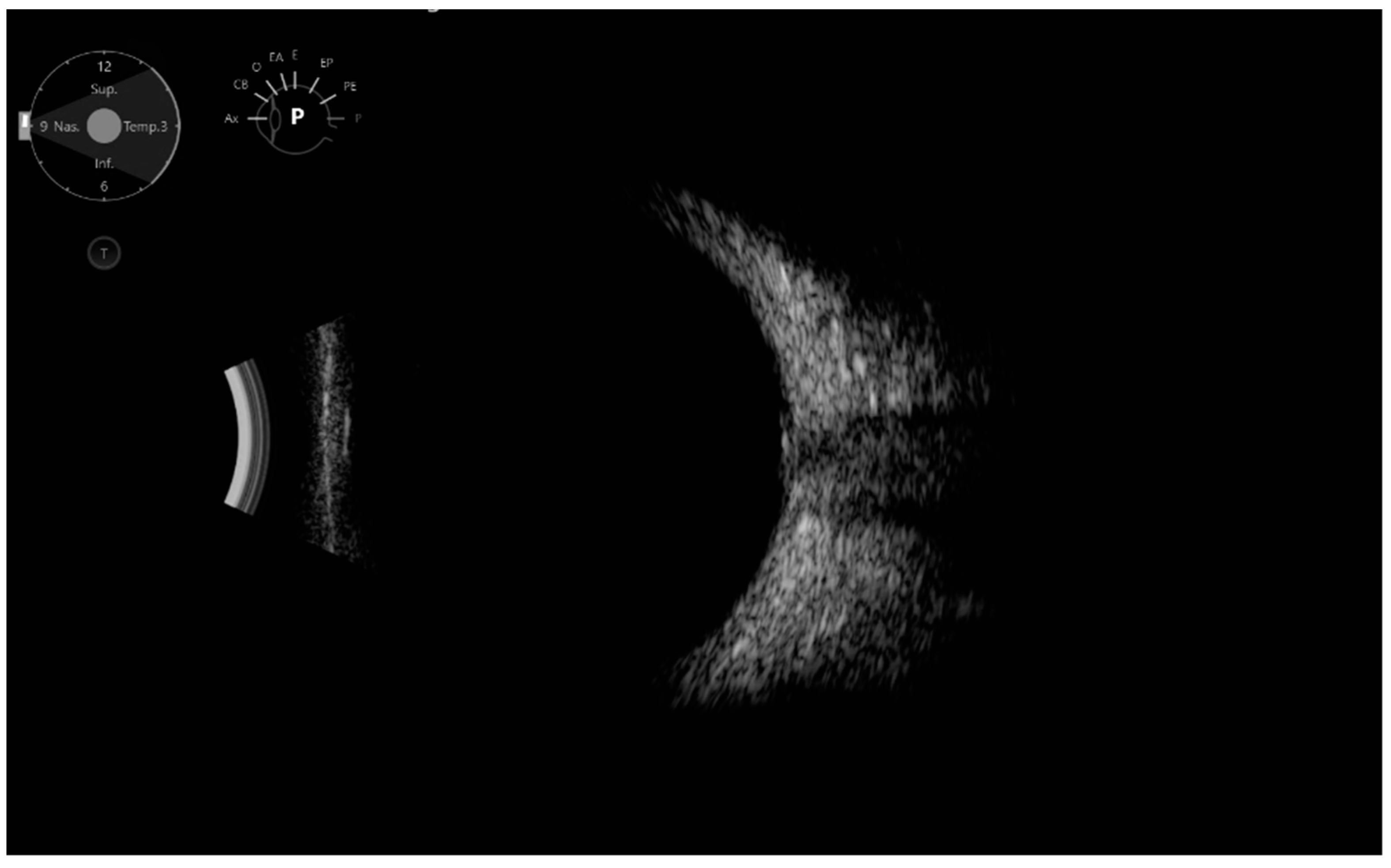 Optic Disc Drusen B Scan