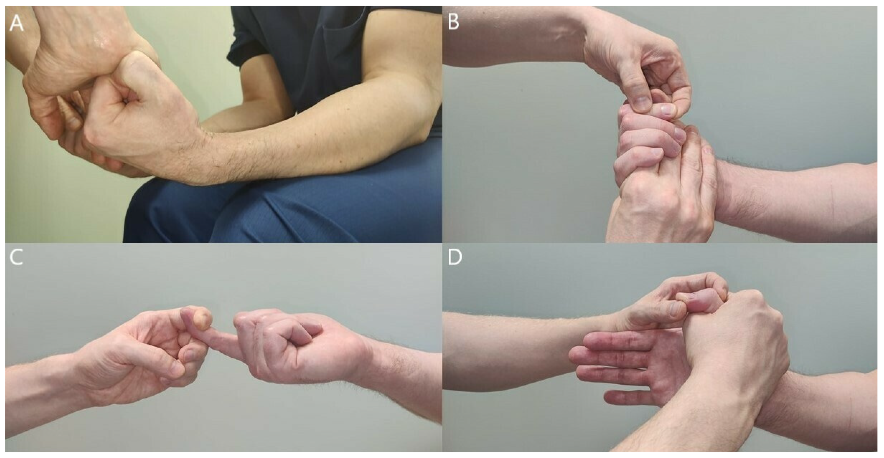 JCM | Free Full-Text | Proximal Median Nerve Compression in the  Differential Diagnosis of Carpal Tunnel Syndrome
