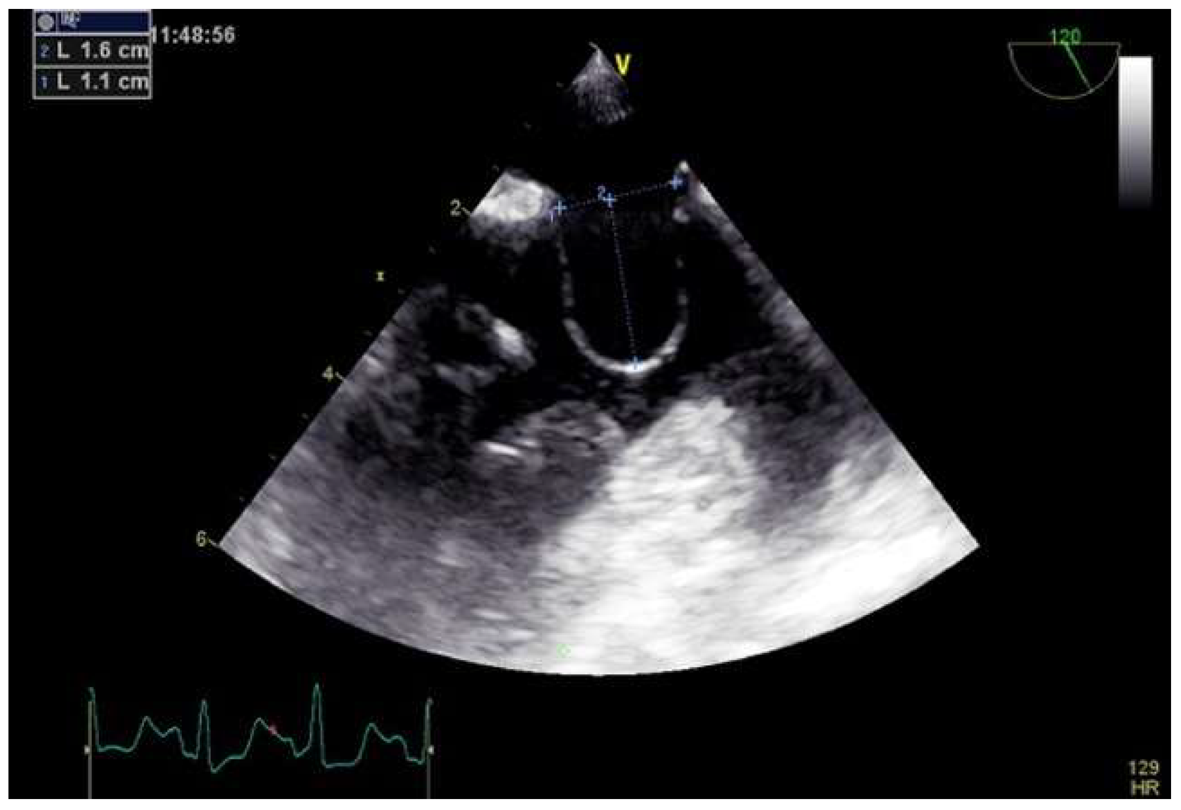 JCM | Free Full-Text | Advances in Percutaneous Patent Foramen Ovale ...