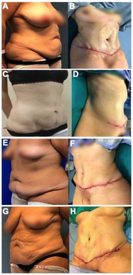 JCM | Free Full-Text | Post-Bariatric Plastic Surgery