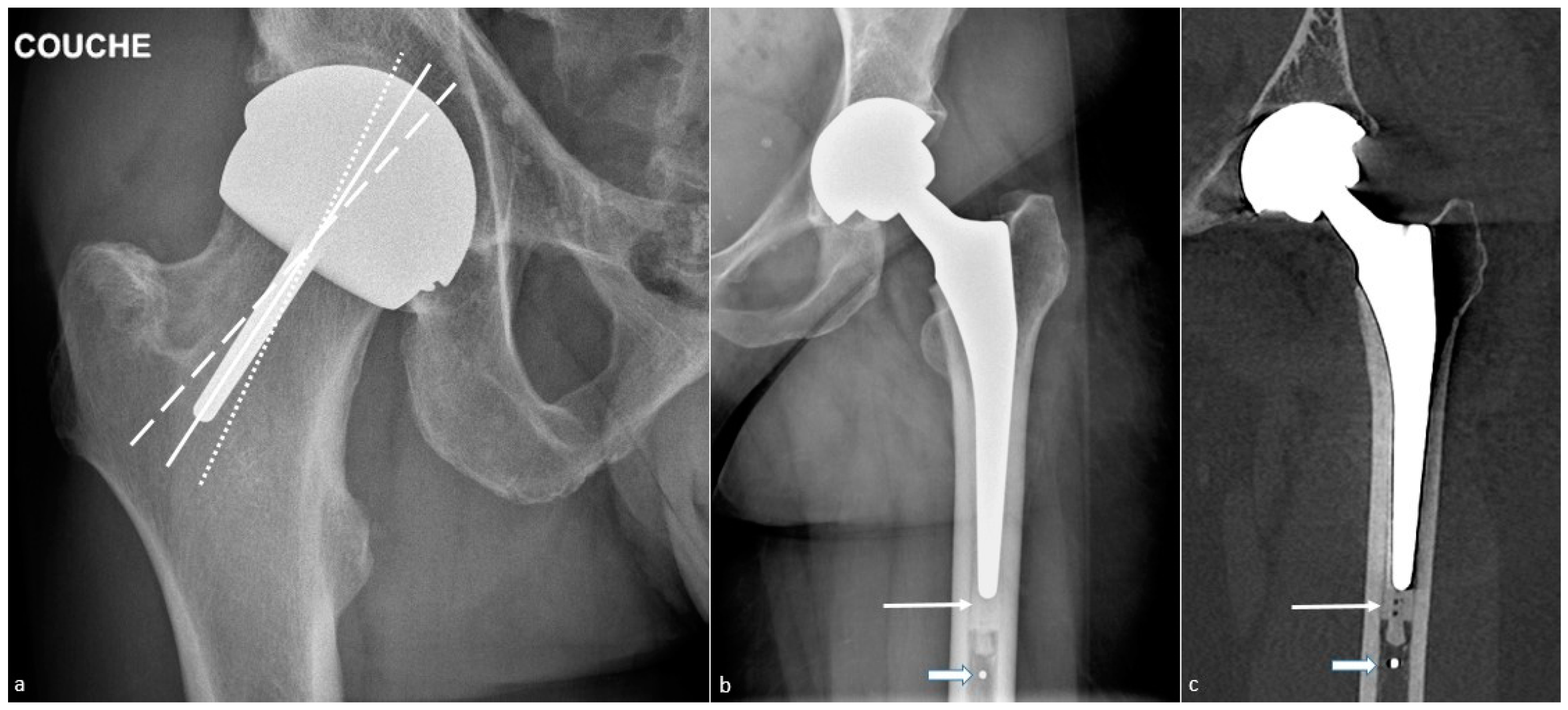 JCM | Free Full-Text | Imaging in Hip Arthroplasty Management Part 2:  Postoperative Diagnostic Imaging Strategy