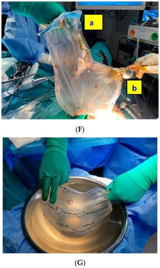 The 12-mm trocar is placed into the bag through the umbilical incision....  | Download Scientific Diagram