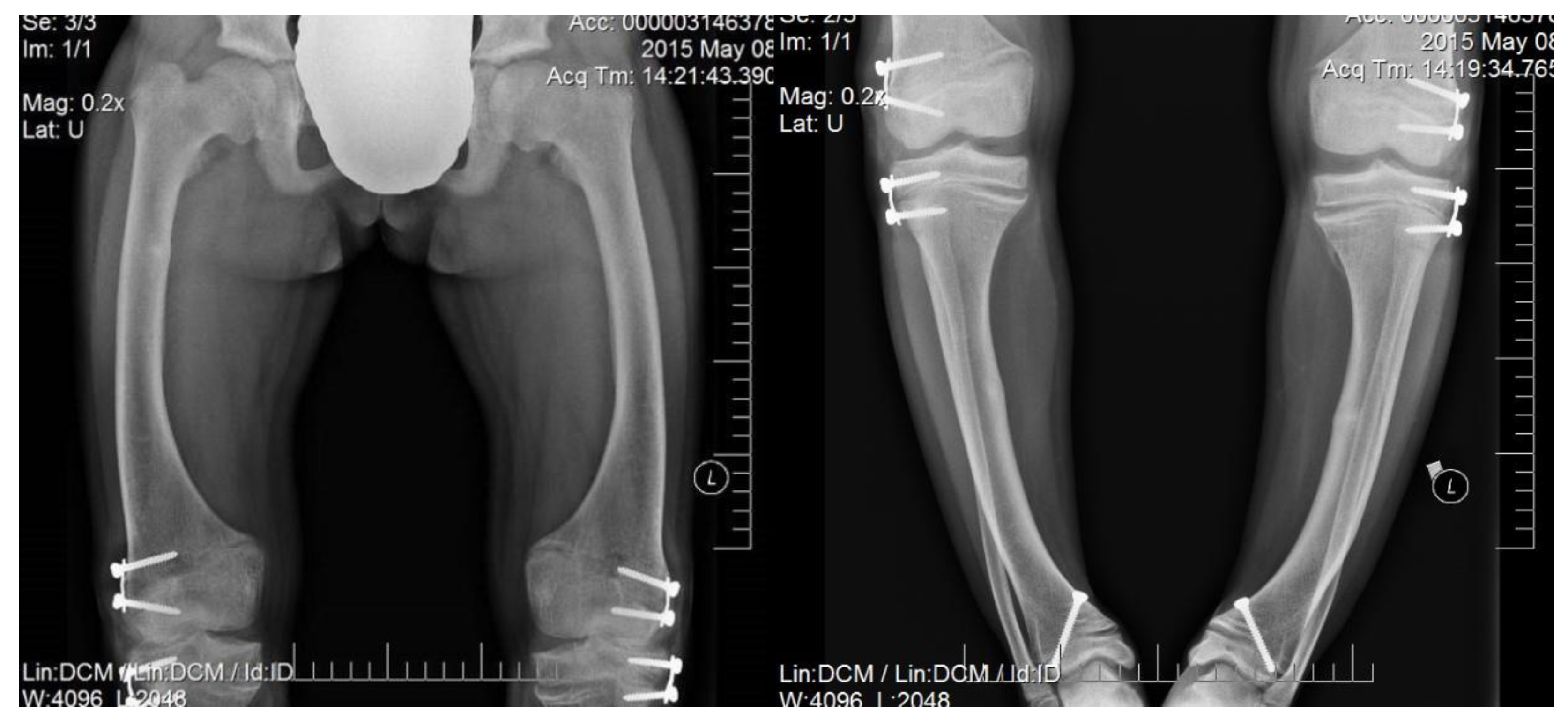 JCM | Free Full-Text | Bone Turnover Markers and Bone Mineral Density in  Children with Hypophosphatemic Rickets