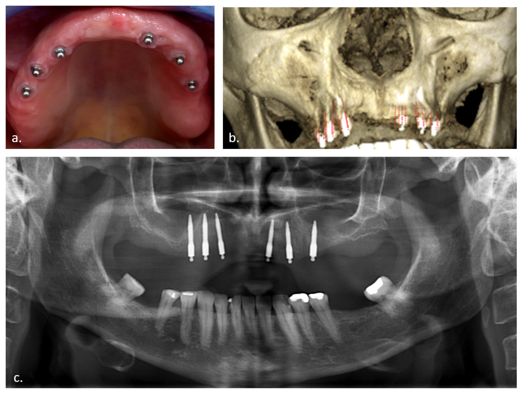 JCM | Free Full-Text | Effect of Sinus Perforation with Flaplessly Placed  Mini Dental Implants for Oral Rehabilitation: A 5-Year Clinical and  Radiological Follow-Up