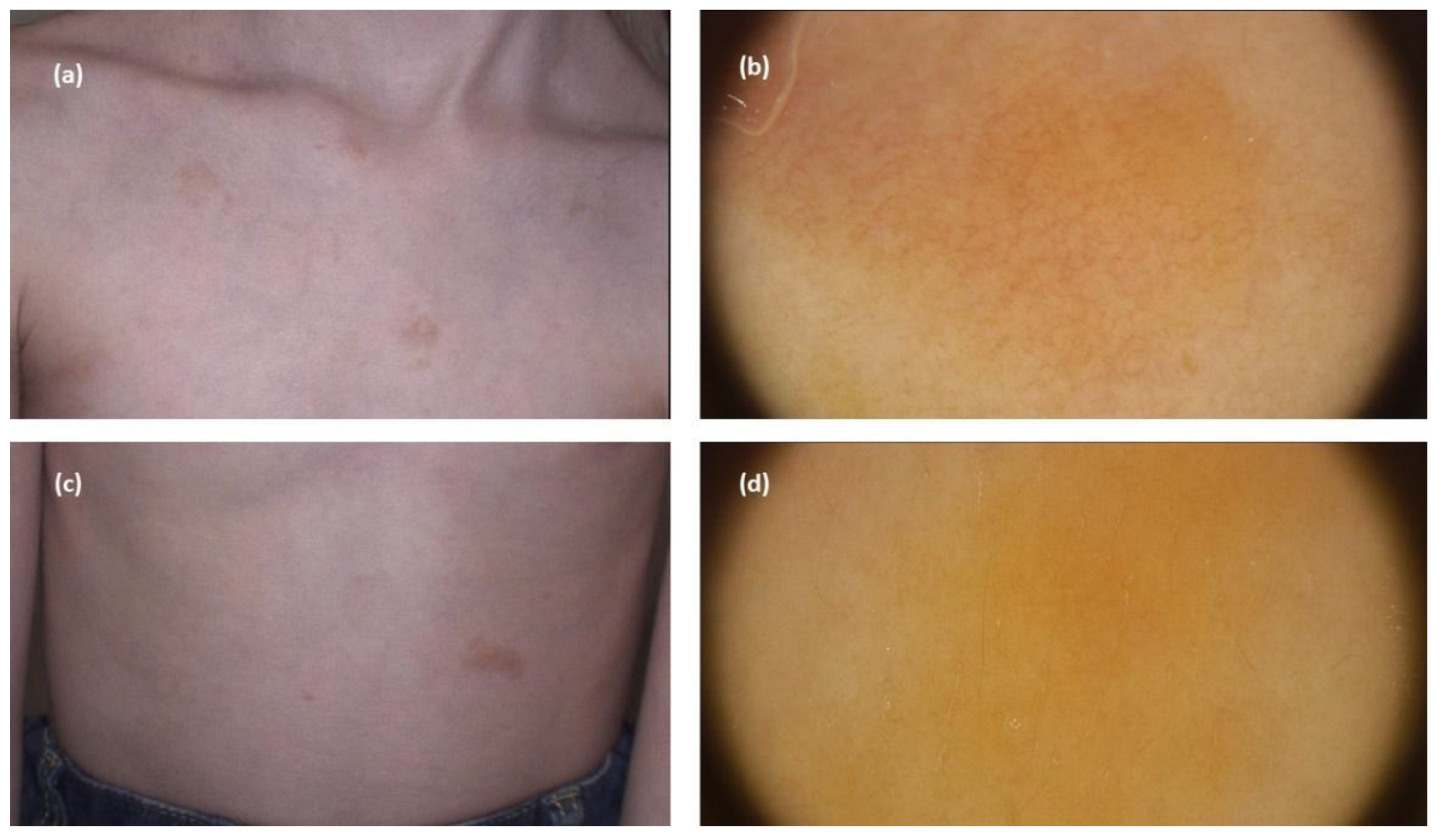 JCM | Free Full-Text | Dermoscopic Features of Different Forms of Cutaneous  Mastocytosis: A Systematic Review | HTML