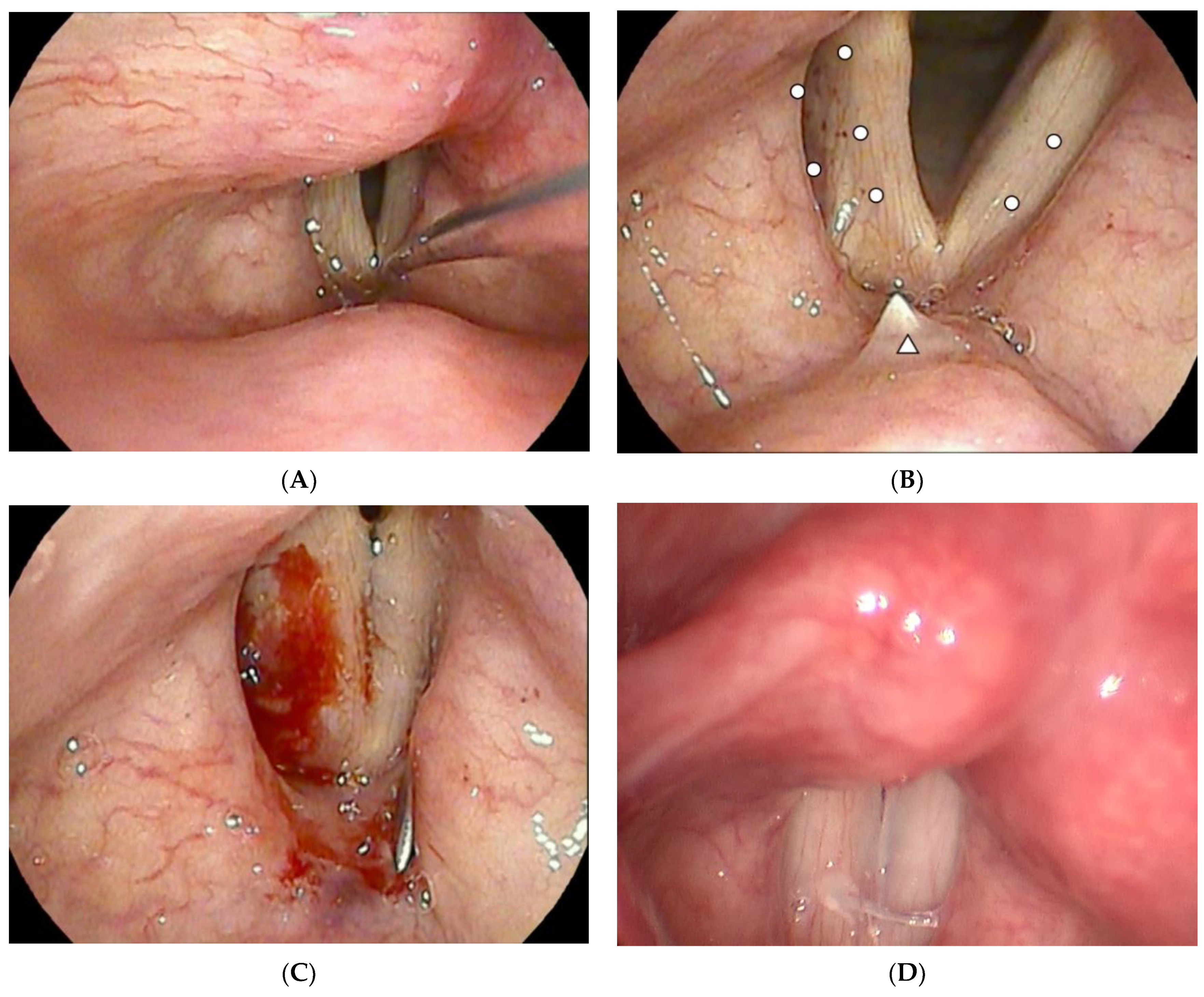 JCM | Free Full-Text | Office-Based Structural Autologous Fat Injection  Laryngoplasty for Unilateral Vocal Fold Paralysis