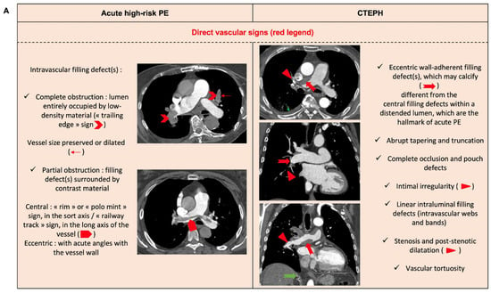 JCM | Free Full-Text | An Update on the Management of Acute High-Risk ...